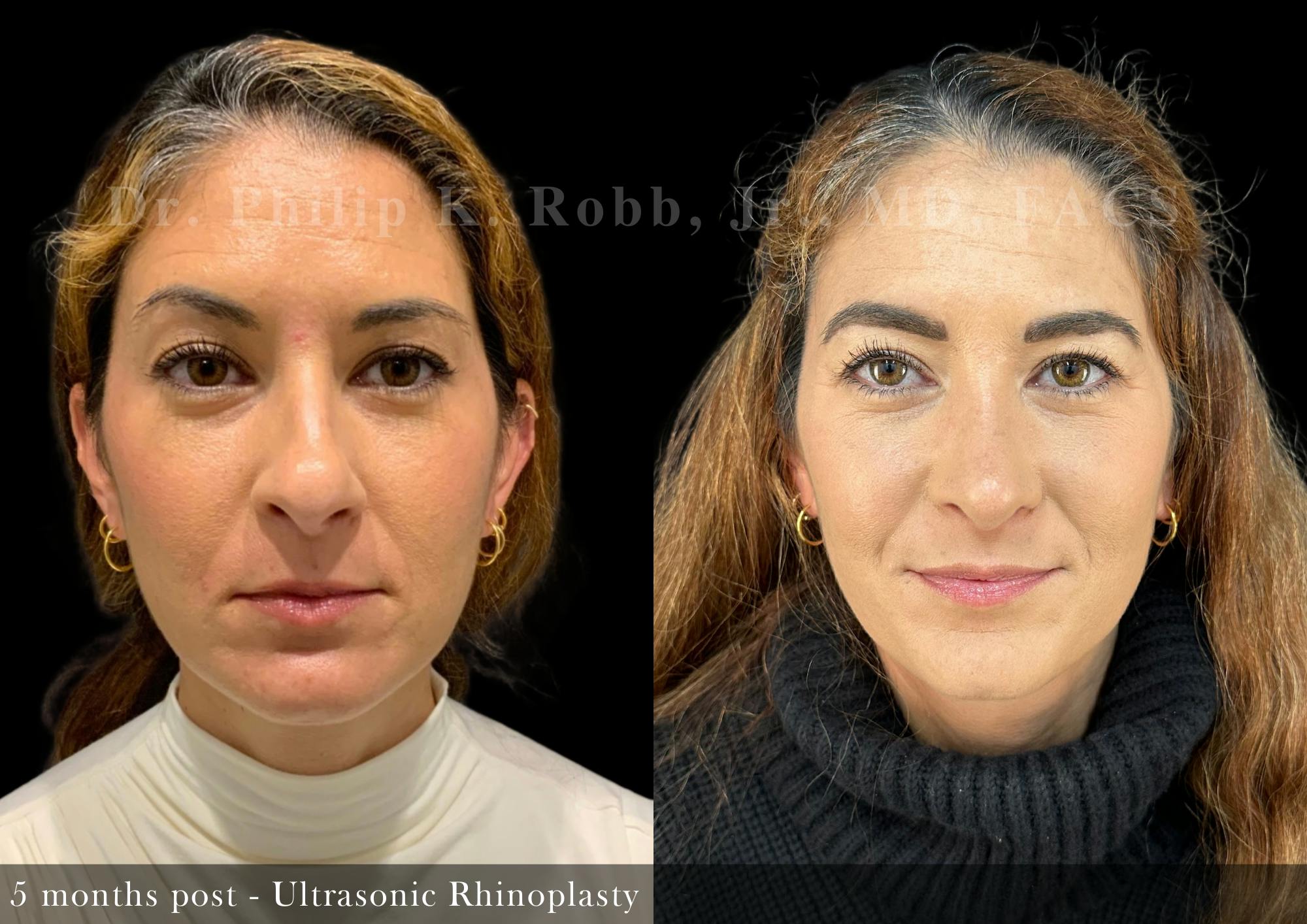 Nose Before & After Gallery - Patient 485237 - Image 3