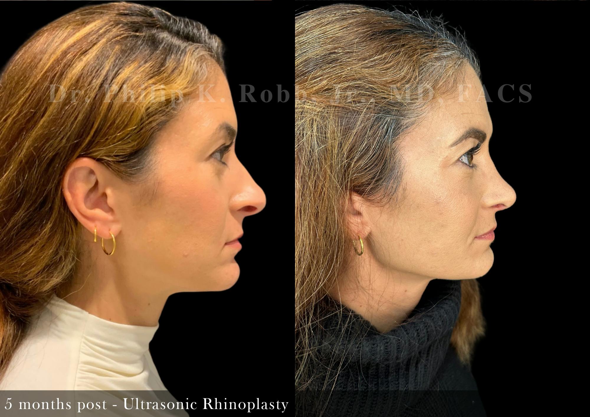 Nose Before & After Gallery - Patient 485237 - Image 1