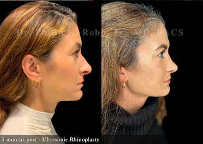 Nose Before & After Gallery - Patient 485237 - Image 1