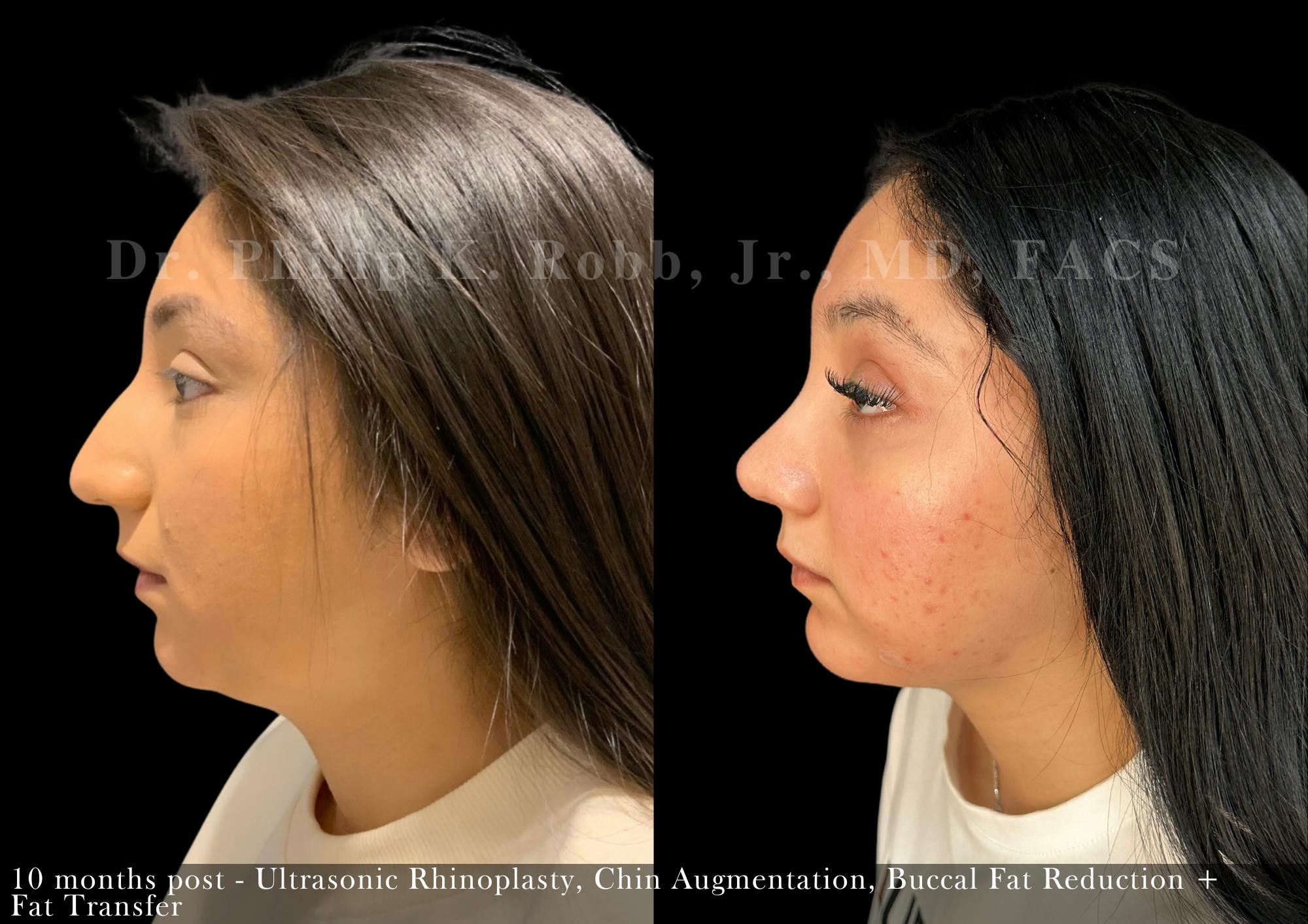 Nose Before & After Gallery - Patient 622074 - Image 2