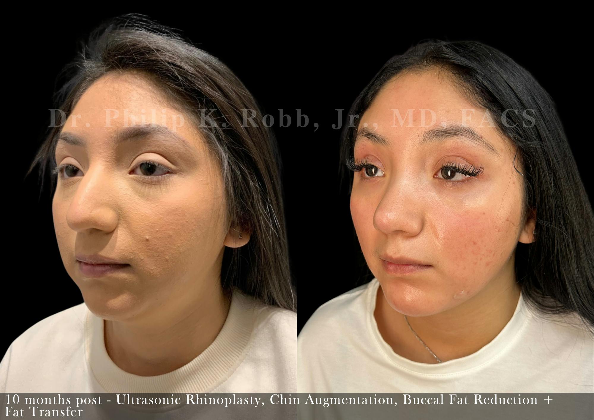 Nose Before & After Gallery - Patient 622074 - Image 3