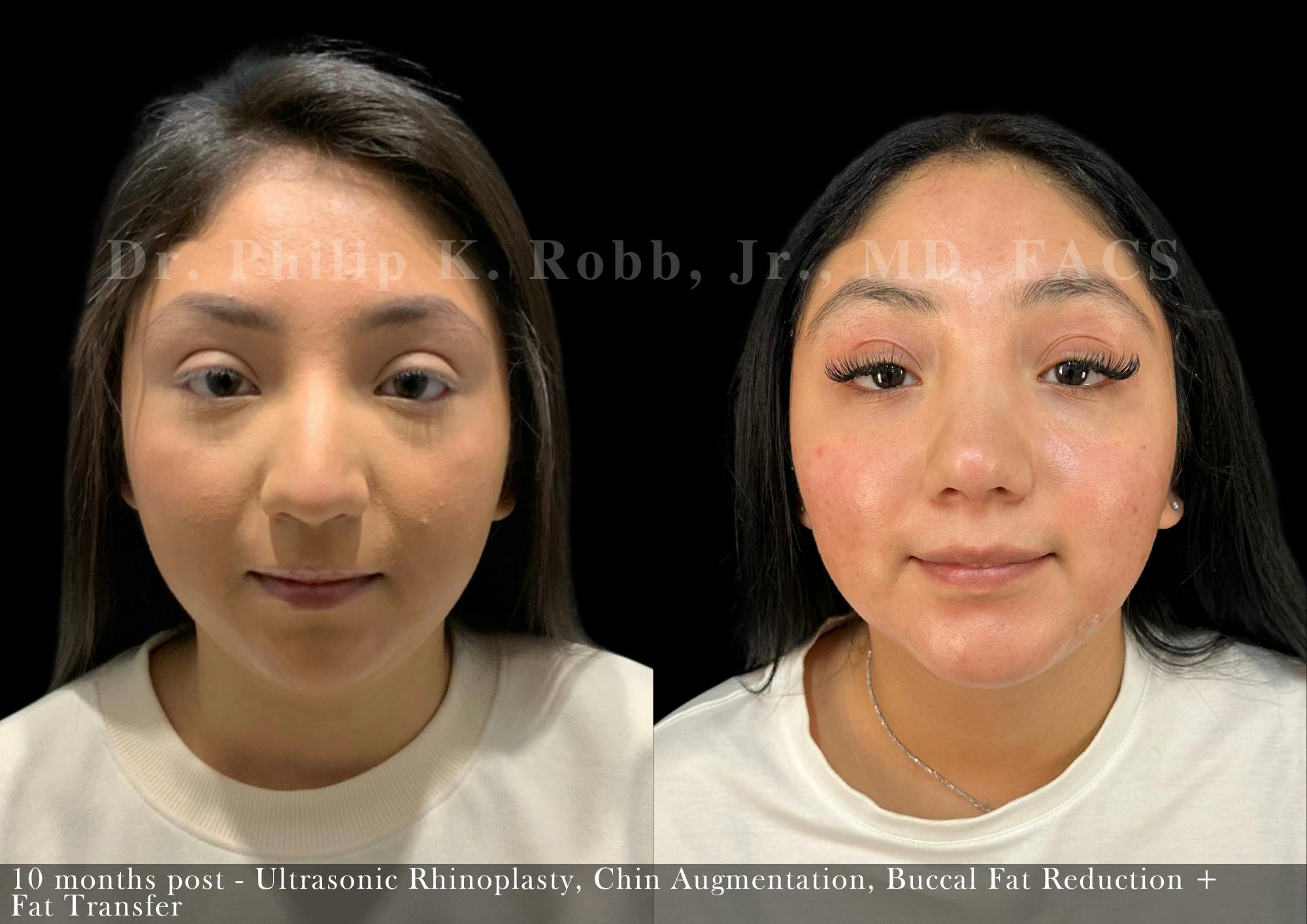 Nose Before & After Gallery - Patient 622074 - Image 5