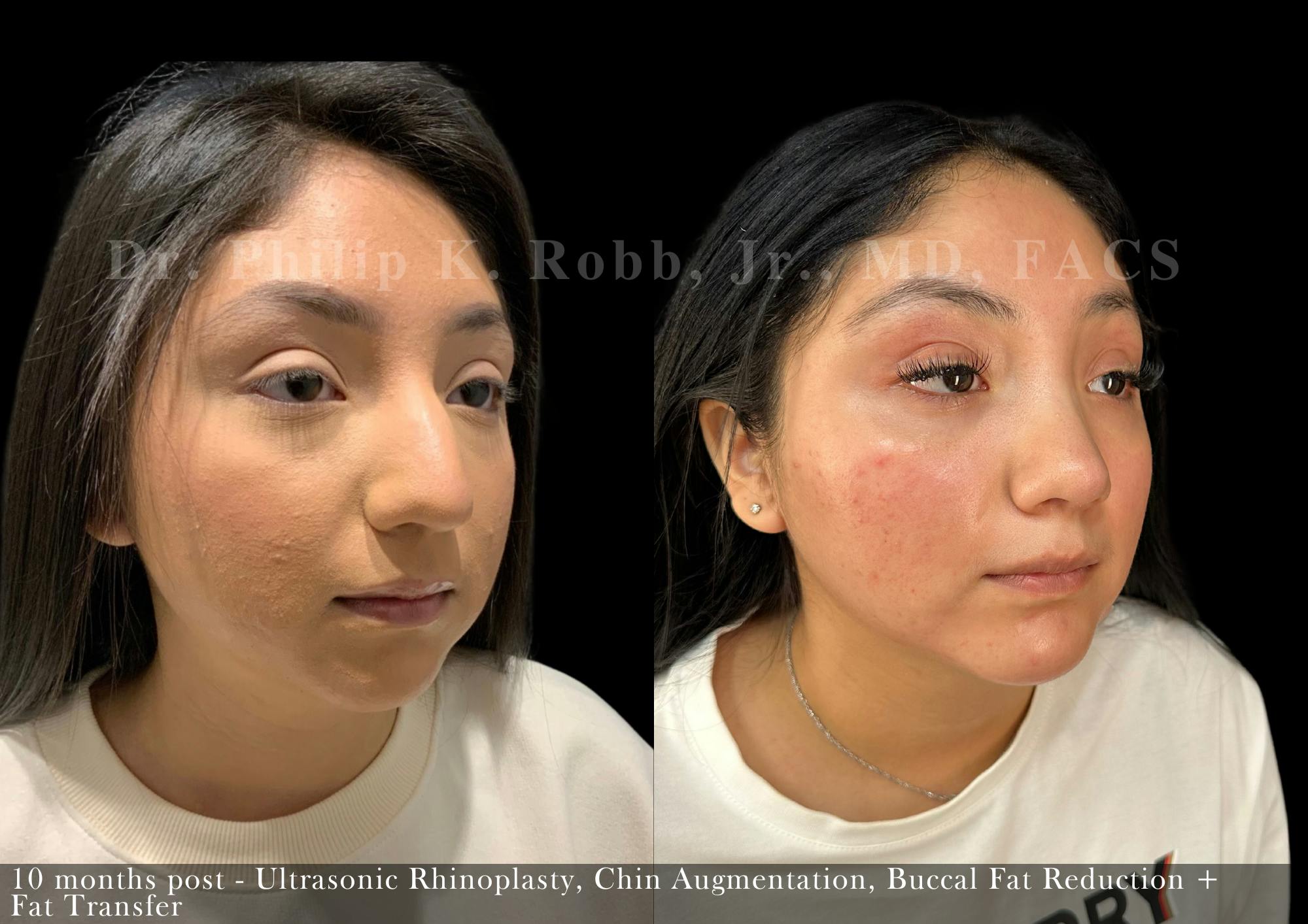 Nose Before & After Gallery - Patient 622074 - Image 4
