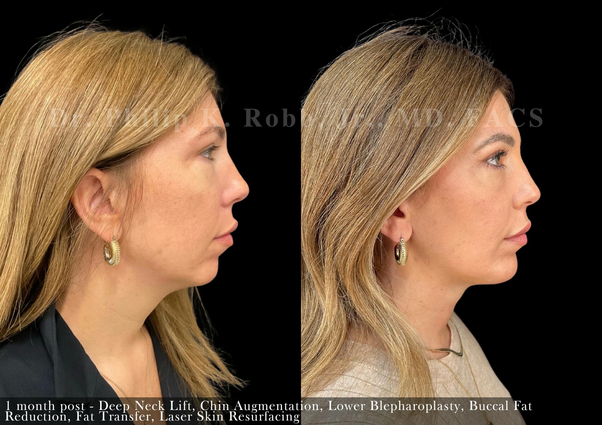 Face Before & After Gallery - Patient 206305616 - Image 3