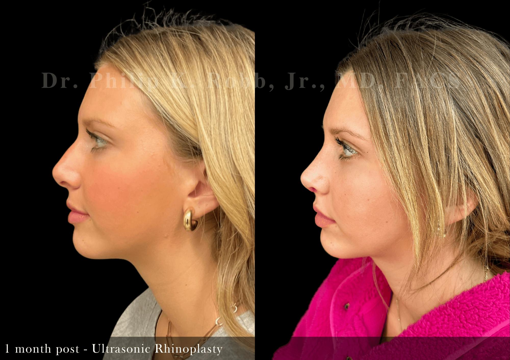 Nose Before & After Gallery - Patient 235768 - Image 5