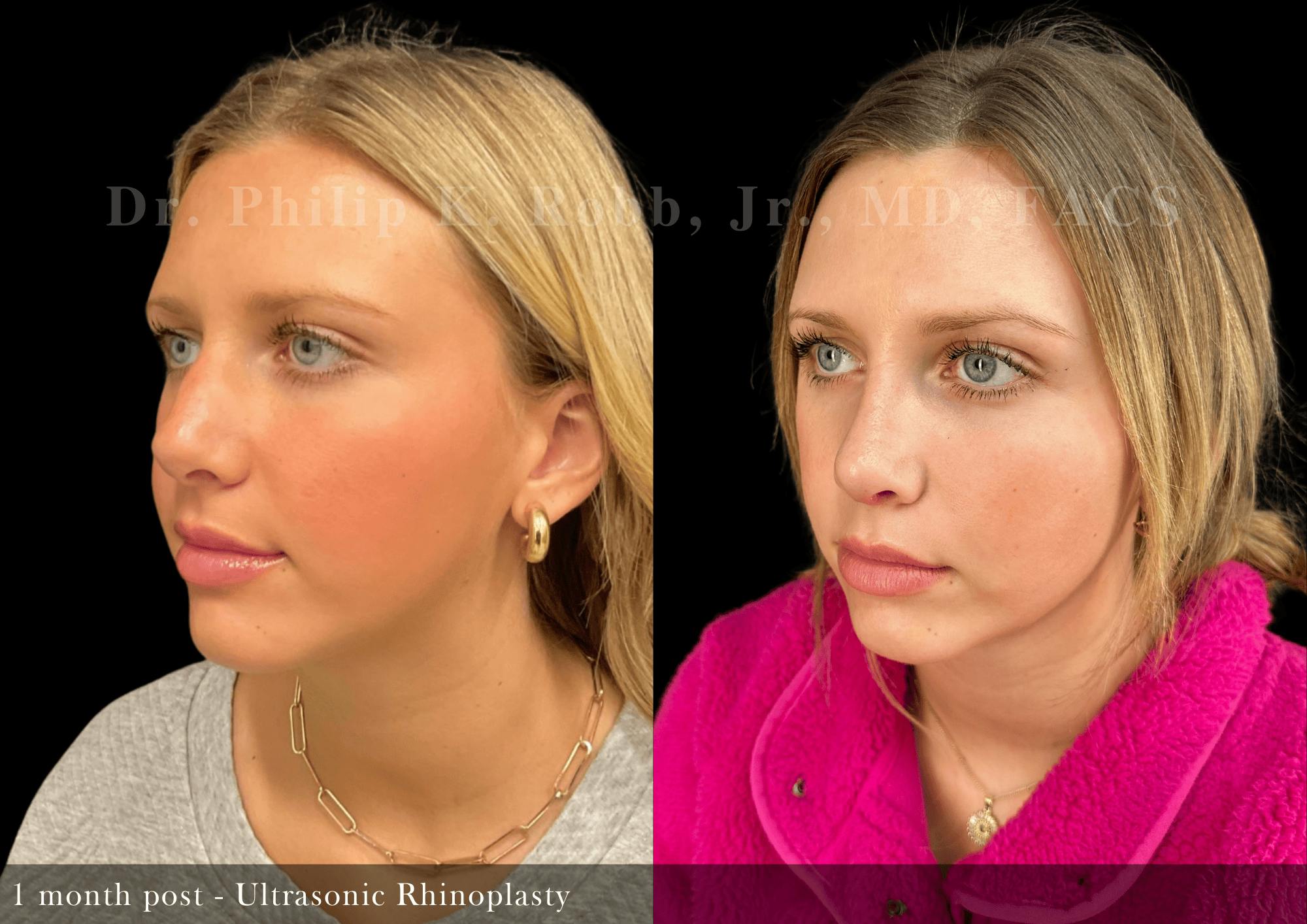 Nose Before & After Gallery - Patient 235768 - Image 4
