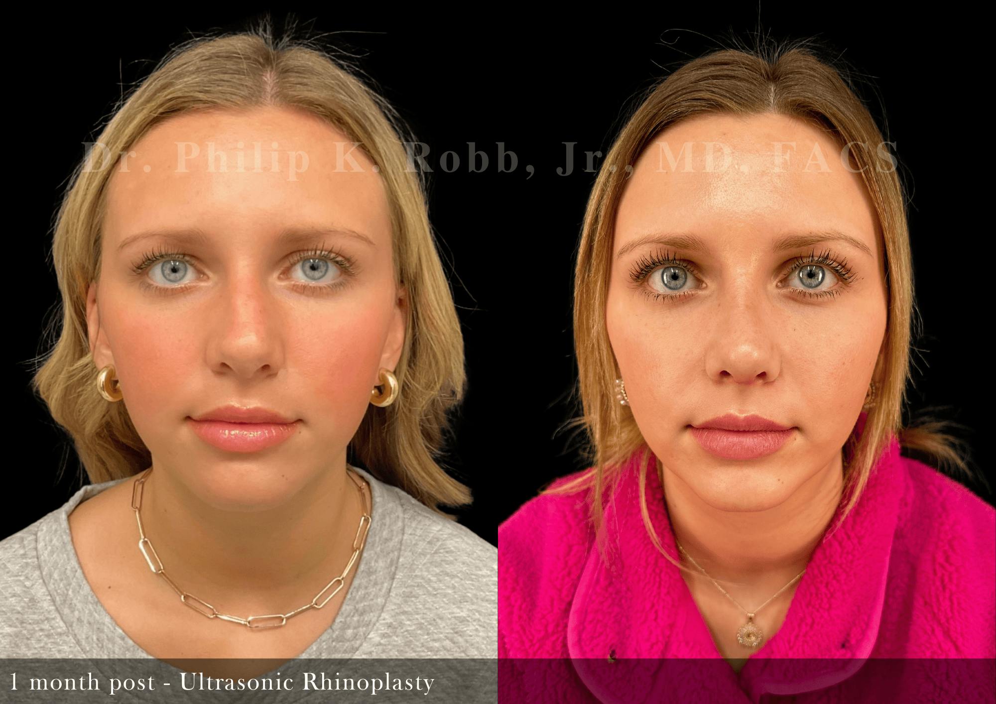 Nose Before & After Gallery - Patient 235768 - Image 3