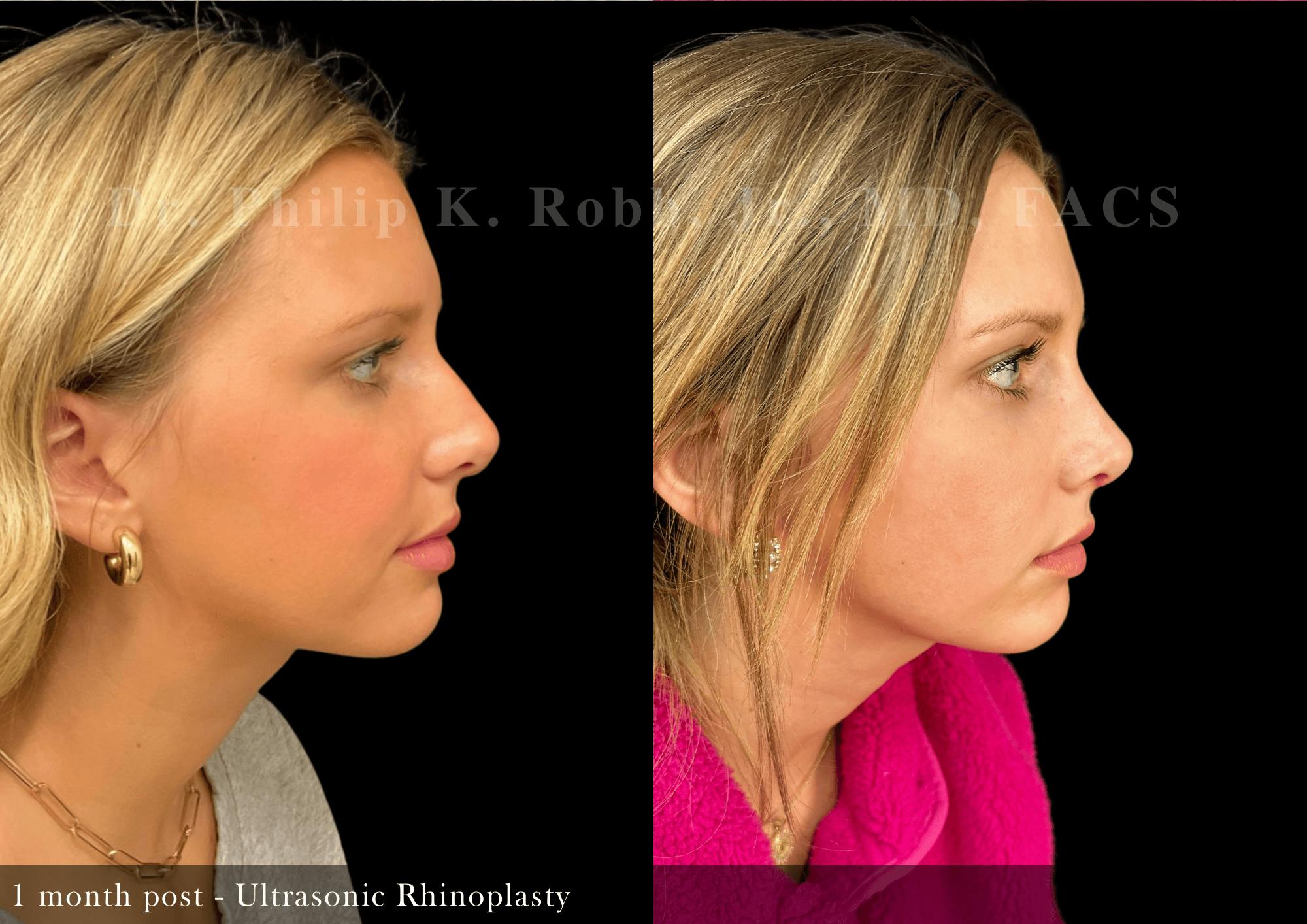 Nose Before & After Gallery - Patient 235768 - Image 1