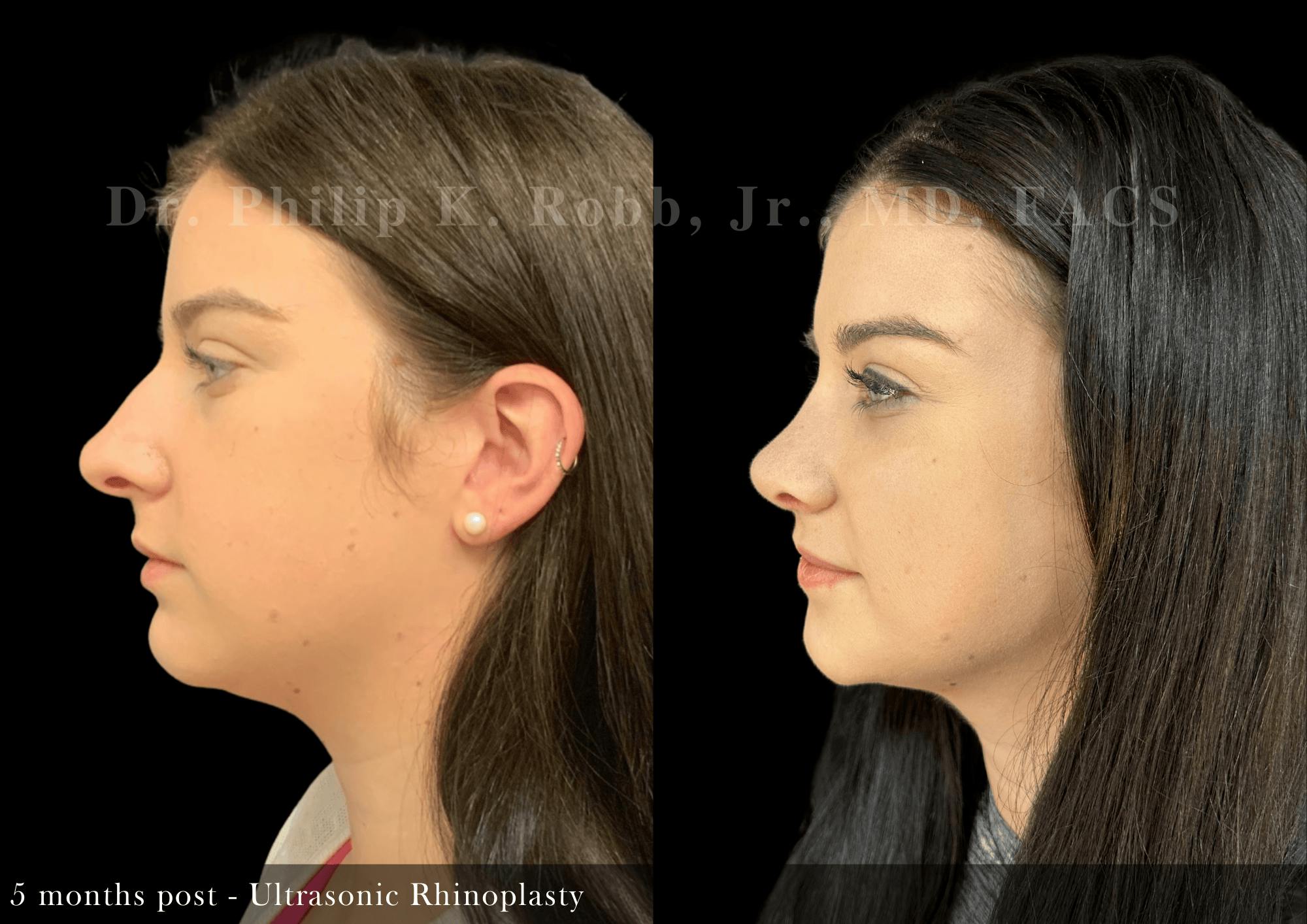 Nose Before & After Gallery - Patient 172690 - Image 5