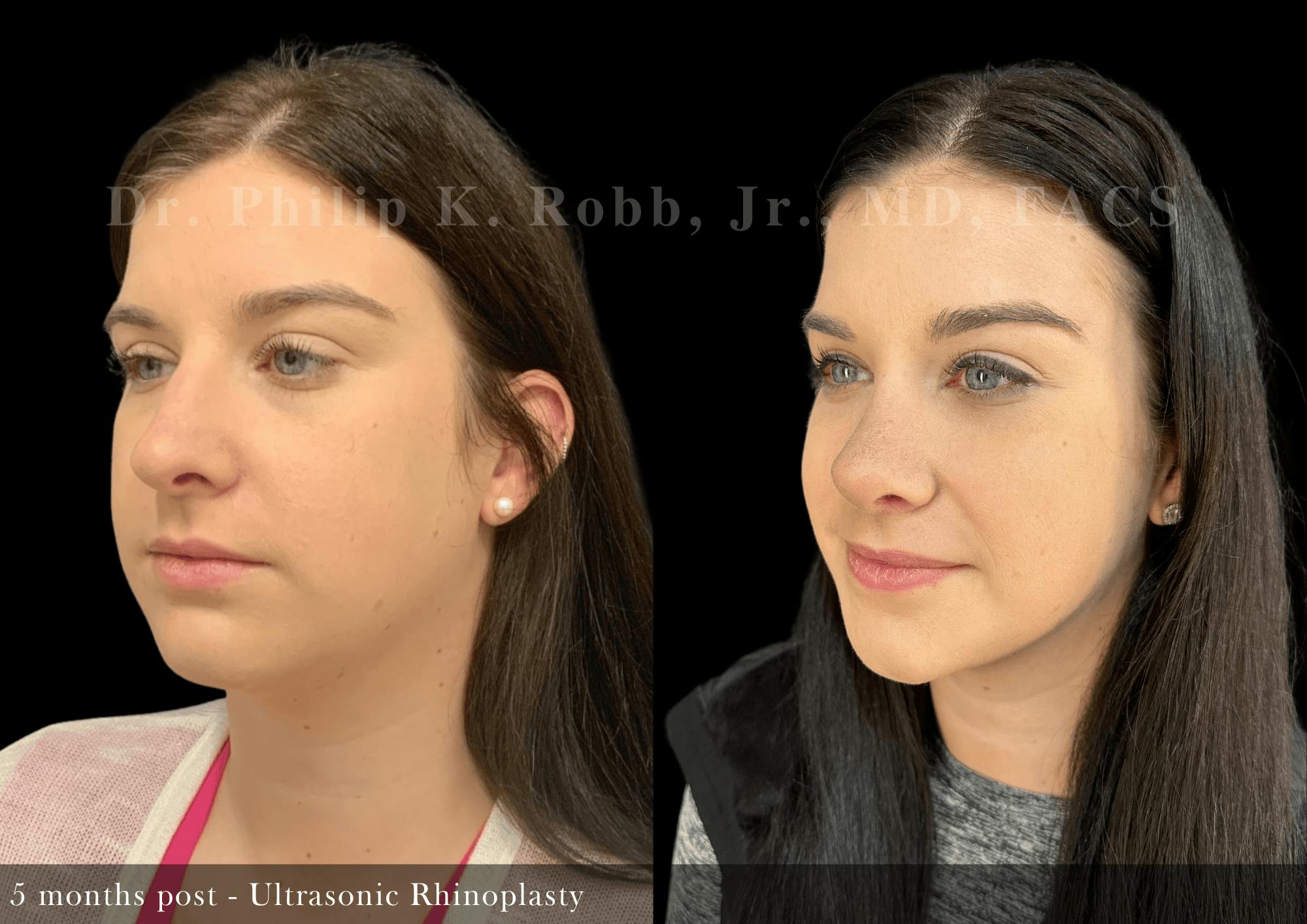 Nose Before & After Gallery - Patient 172690 - Image 4