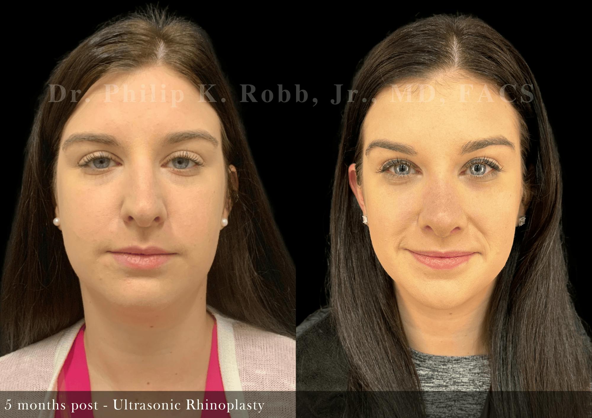 Nose Before & After Gallery - Patient 172690 - Image 3