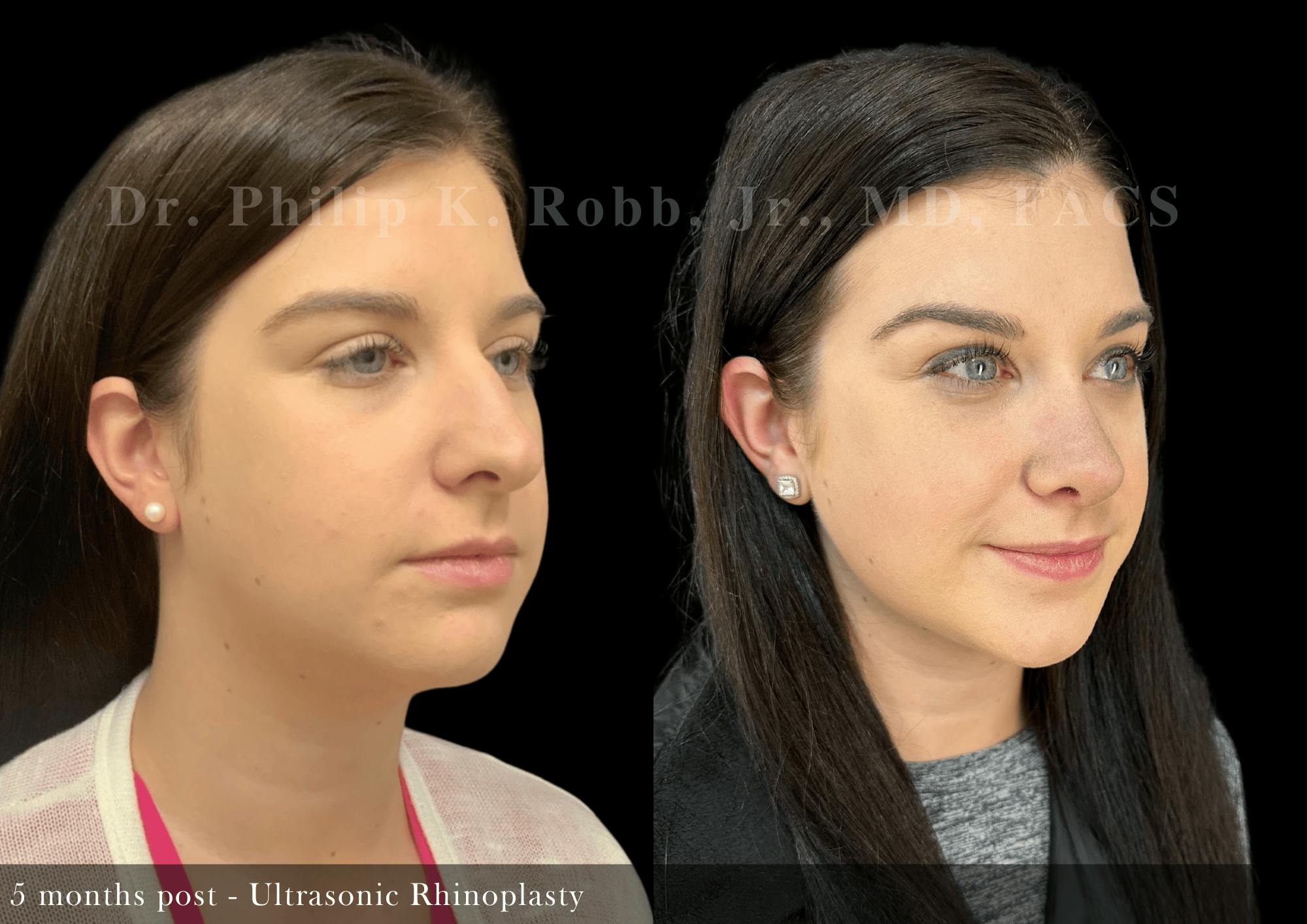 Nose Before & After Gallery - Patient 172690 - Image 2