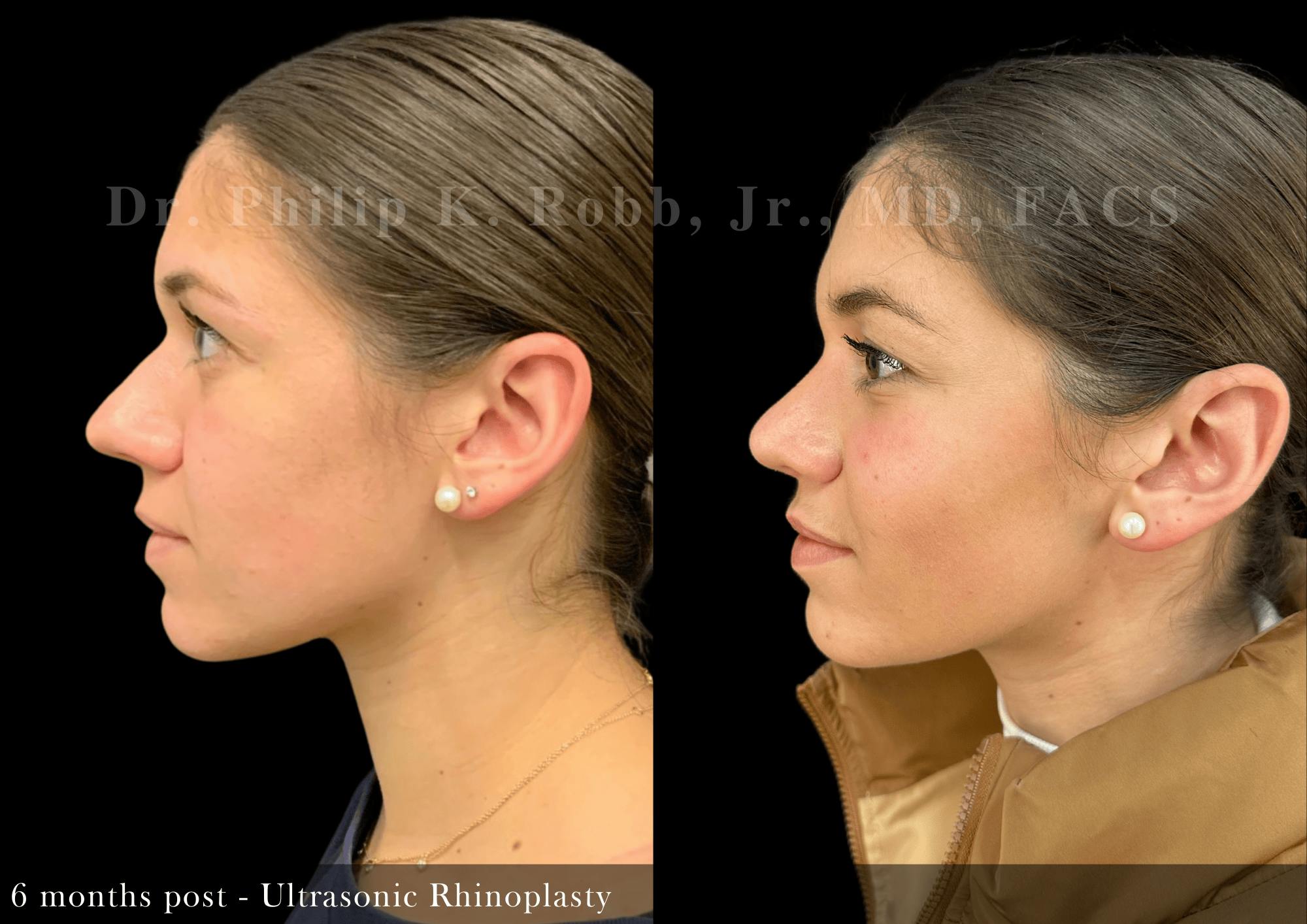 Nose Before & After Gallery - Patient 267398 - Image 5