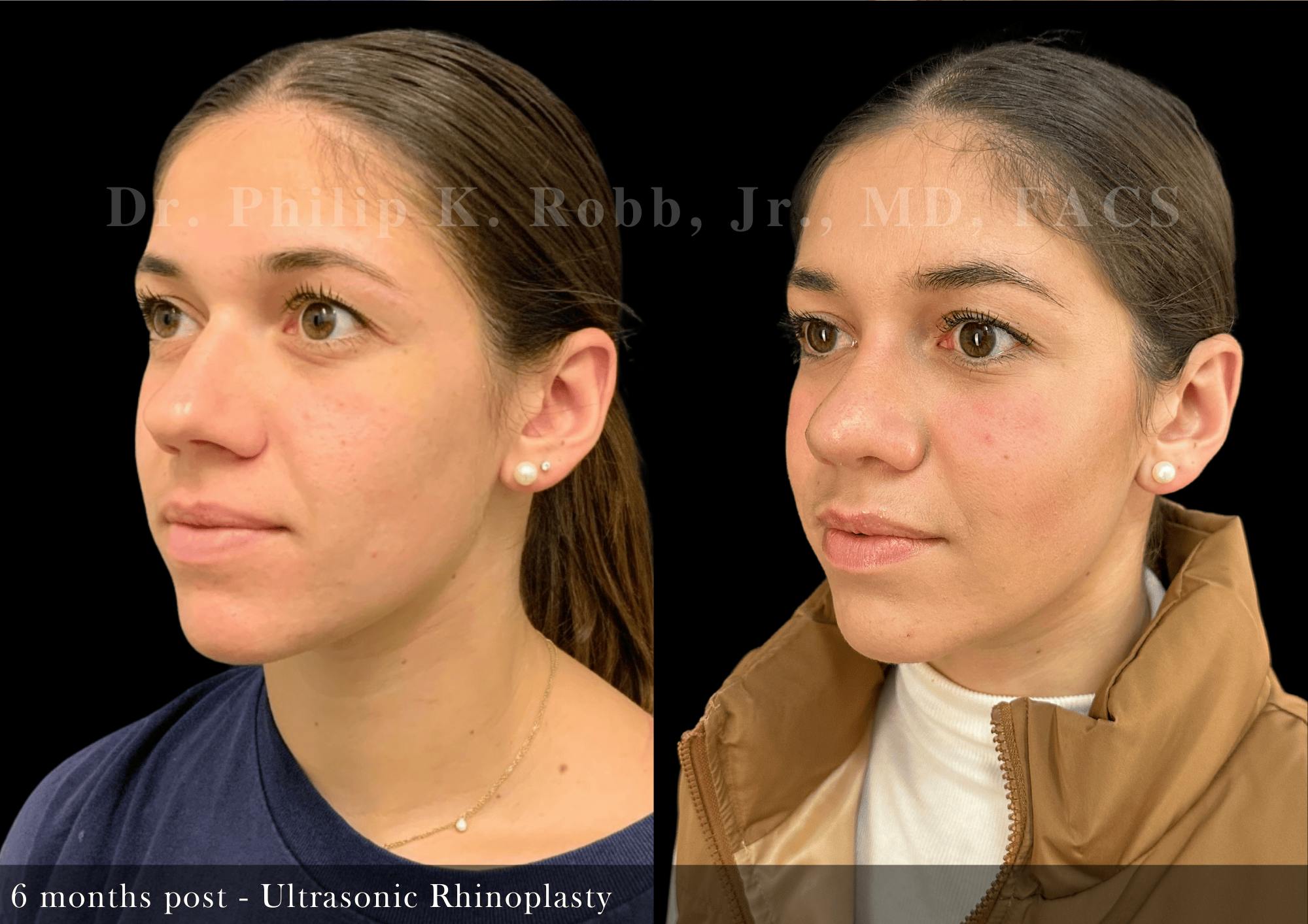 Nose Before & After Gallery - Patient 267398 - Image 4