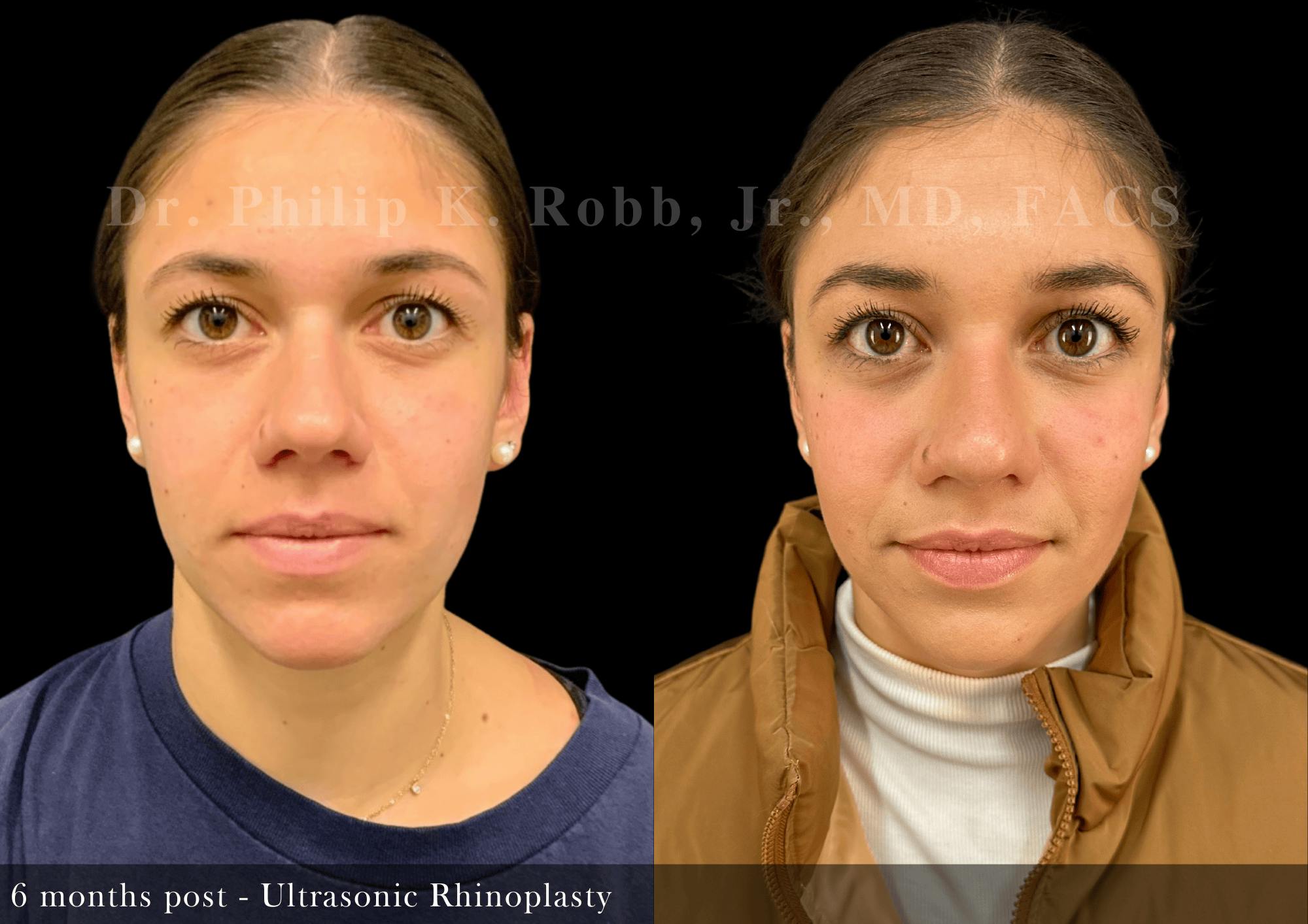 Nose Before & After Gallery - Patient 267398 - Image 3