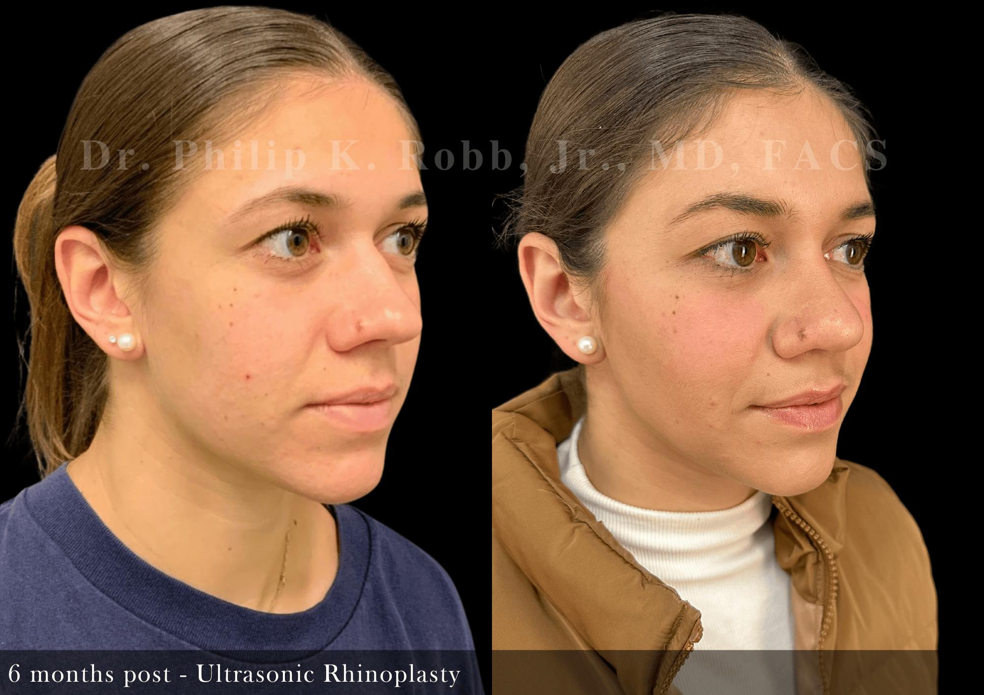 Nose Before & After Gallery - Patient 267398 - Image 2