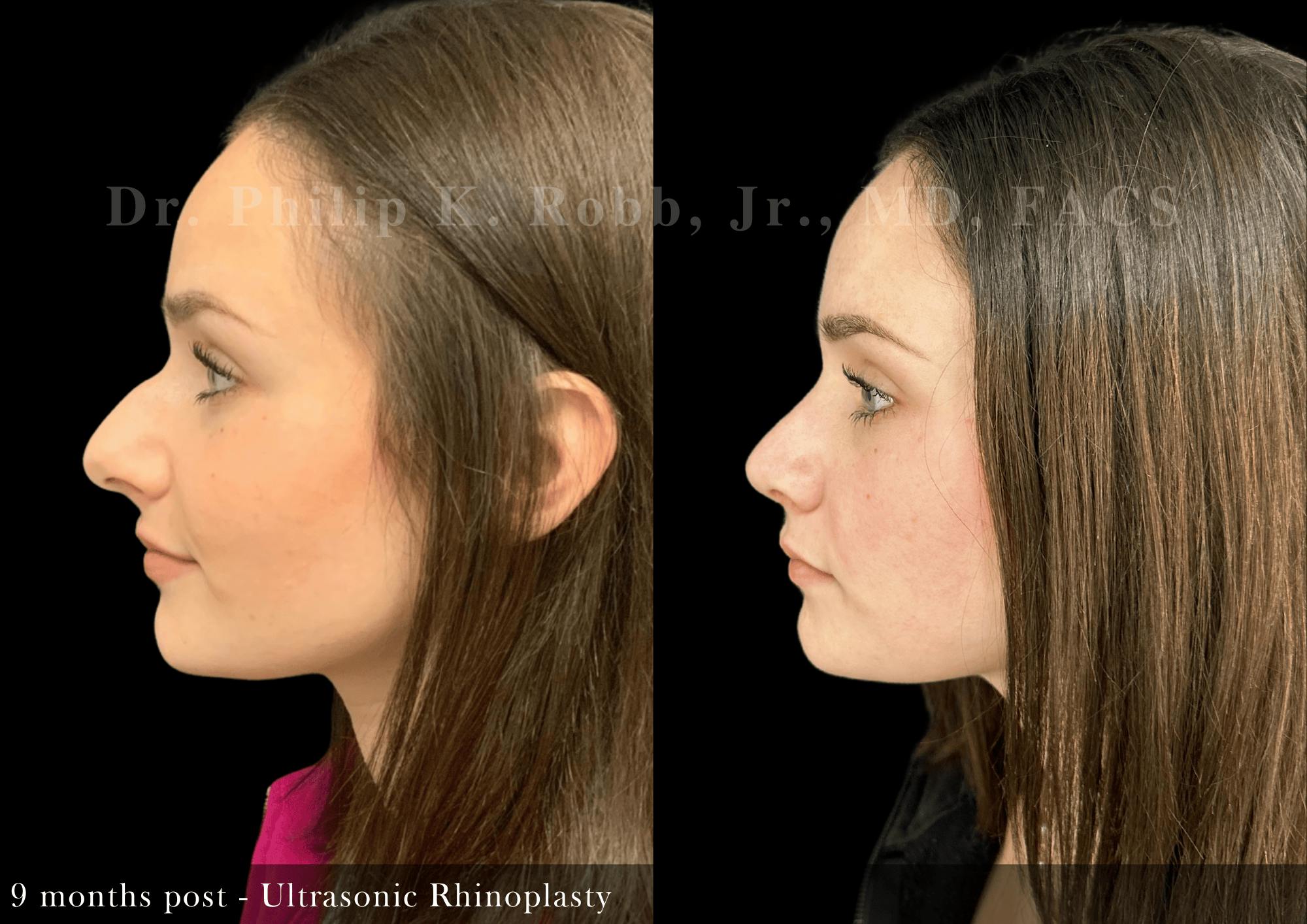 Nose Before & After Gallery - Patient 797552 - Image 5
