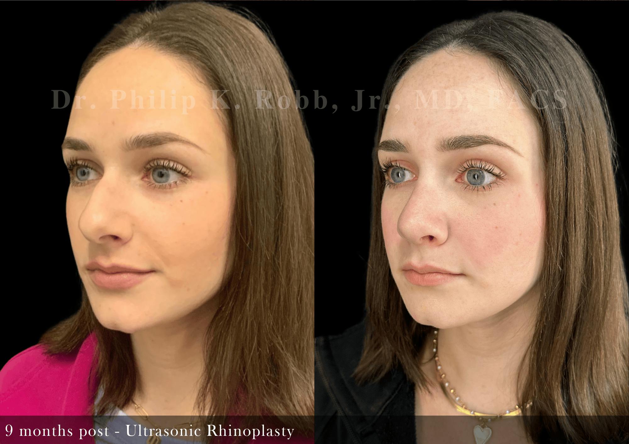 Nose Before & After Gallery - Patient 797552 - Image 4