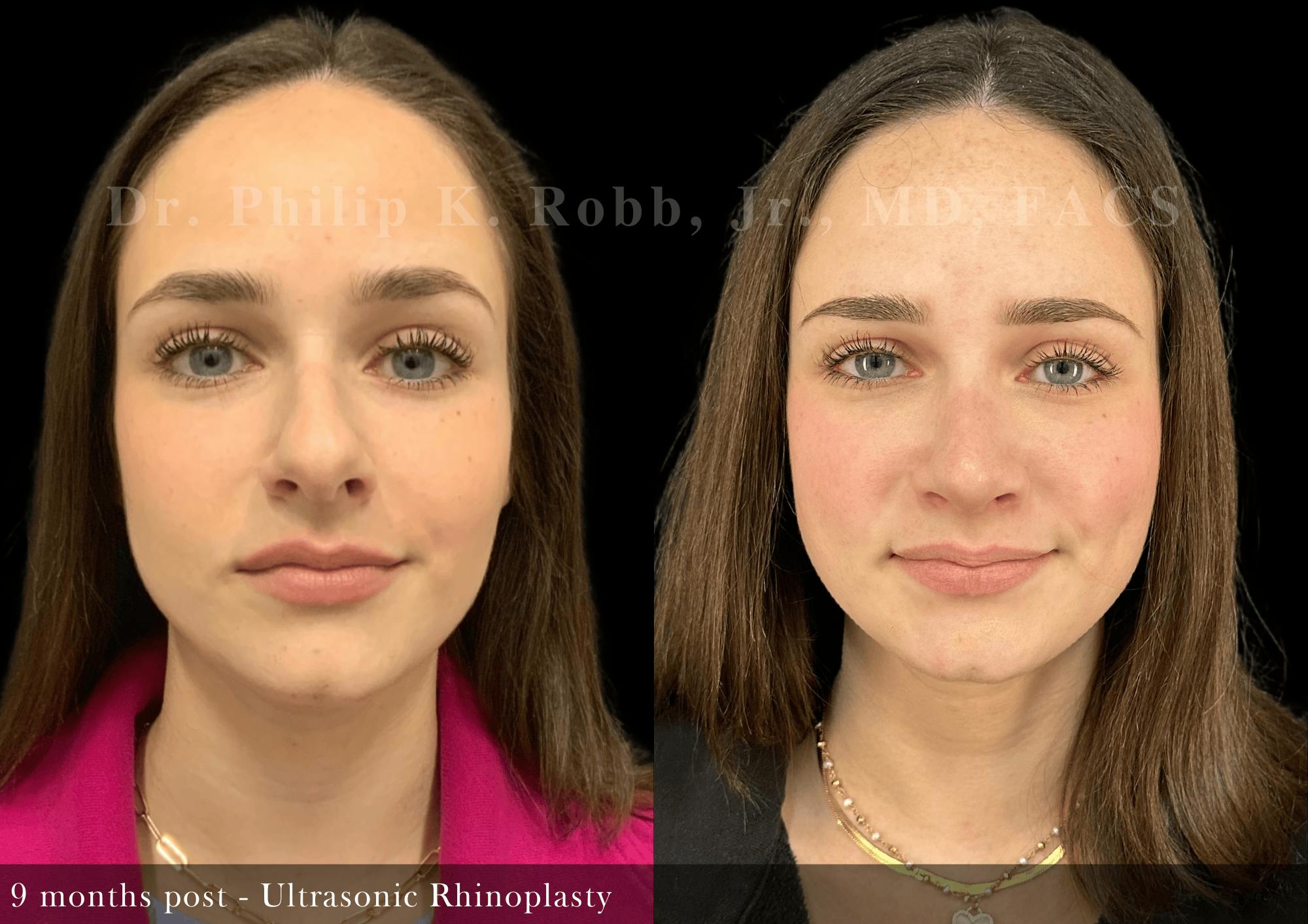 Nose Before & After Gallery - Patient 797552 - Image 3
