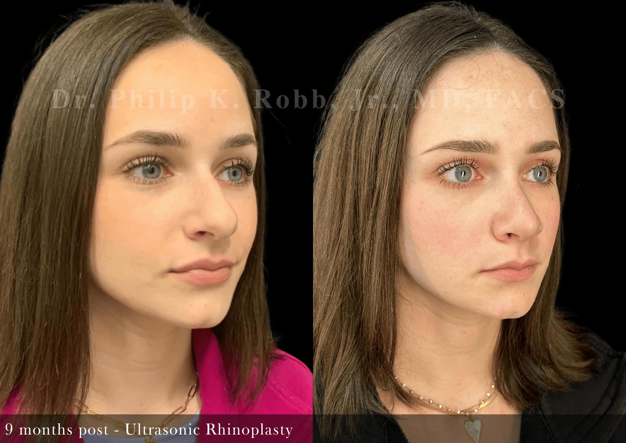 Nose Before & After Gallery - Patient 797552 - Image 2
