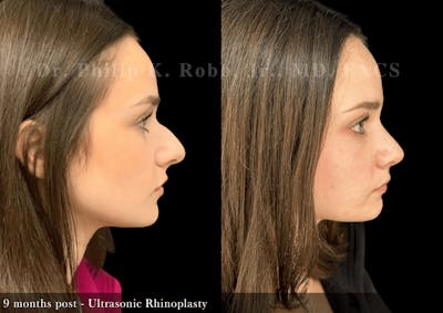 Nose Before & After Gallery - Patient 797552 - Image 1