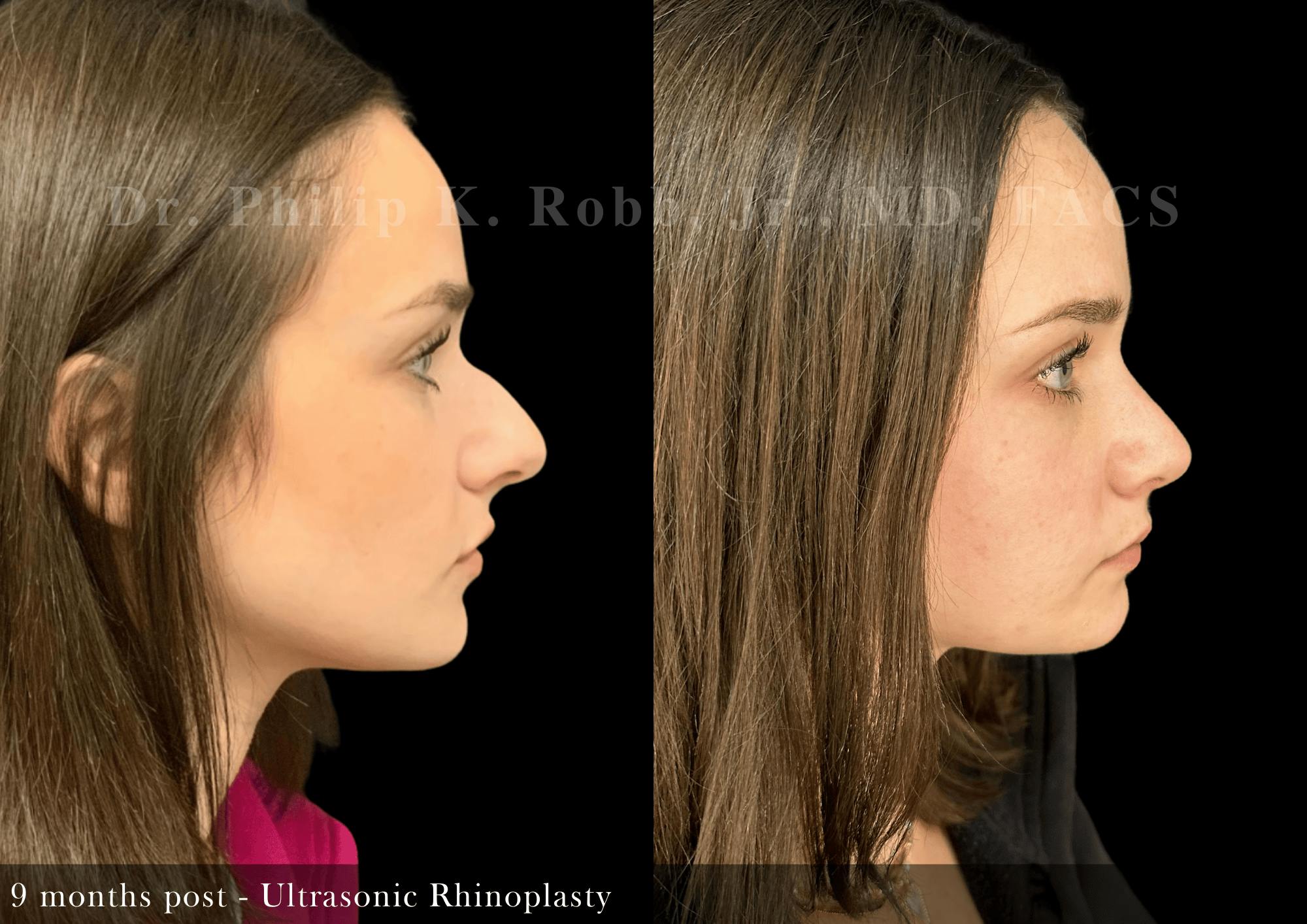 Nose Before & After Gallery - Patient 797552 - Image 1