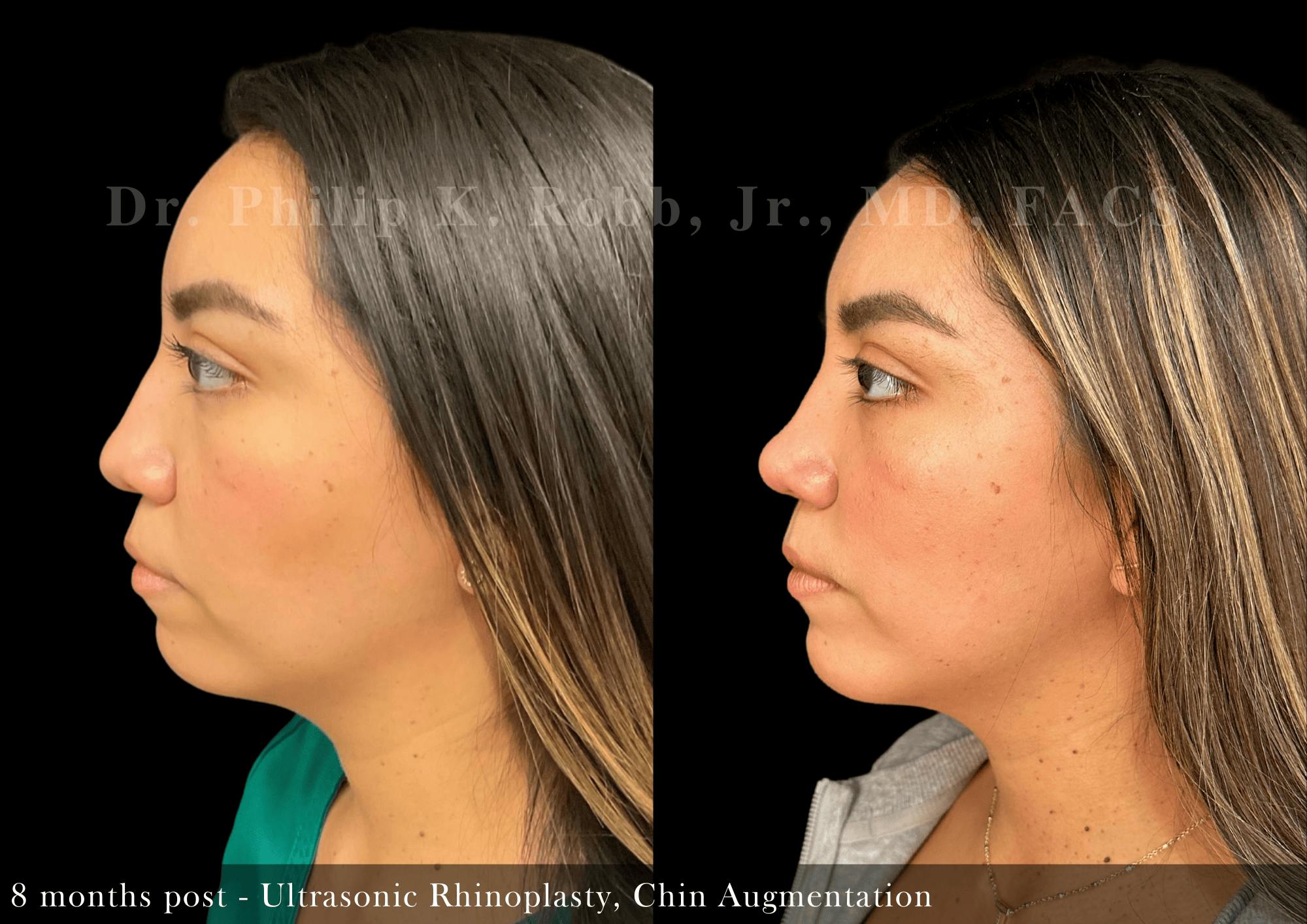 Nose Before & After Gallery - Patient 828153 - Image 5