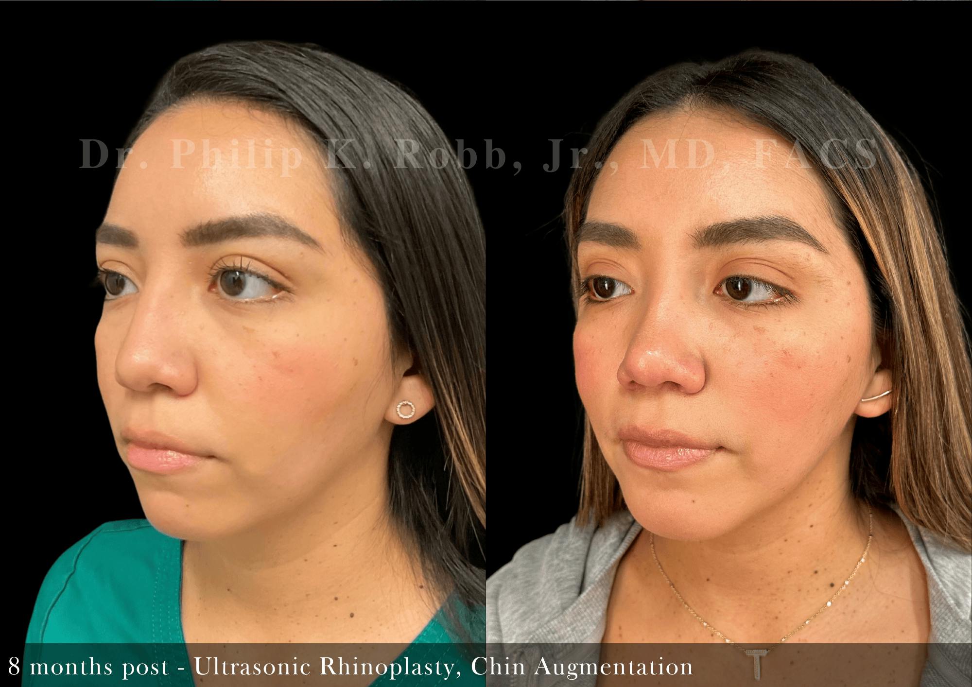Nose Before & After Gallery - Patient 828153 - Image 4