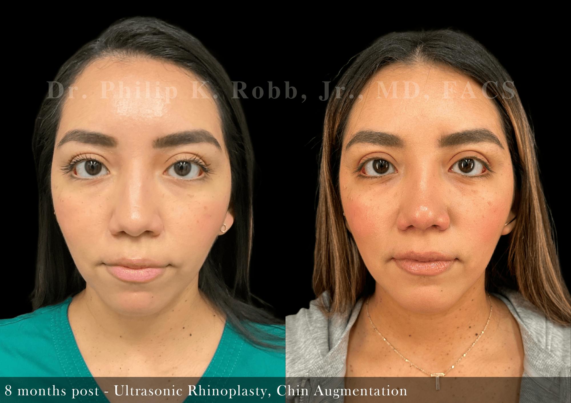 Nose Before & After Gallery - Patient 828153 - Image 3