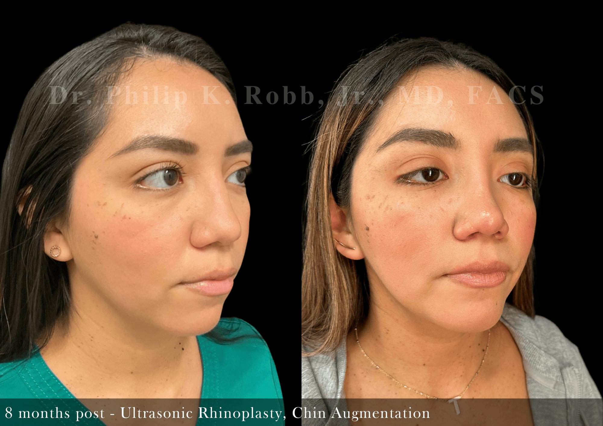 Nose Before & After Gallery - Patient 828153 - Image 2