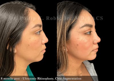 Face Before & After Gallery - Patient 379705 - Image 1