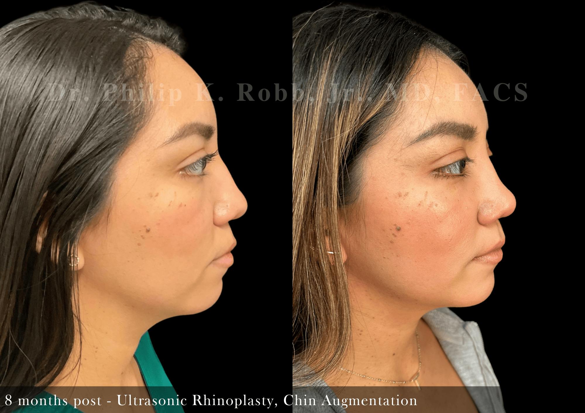 Nose Before & After Gallery - Patient 828153 - Image 1