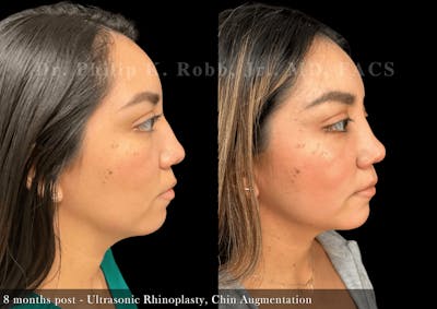 Nose Before & After Gallery - Patient 828153 - Image 1