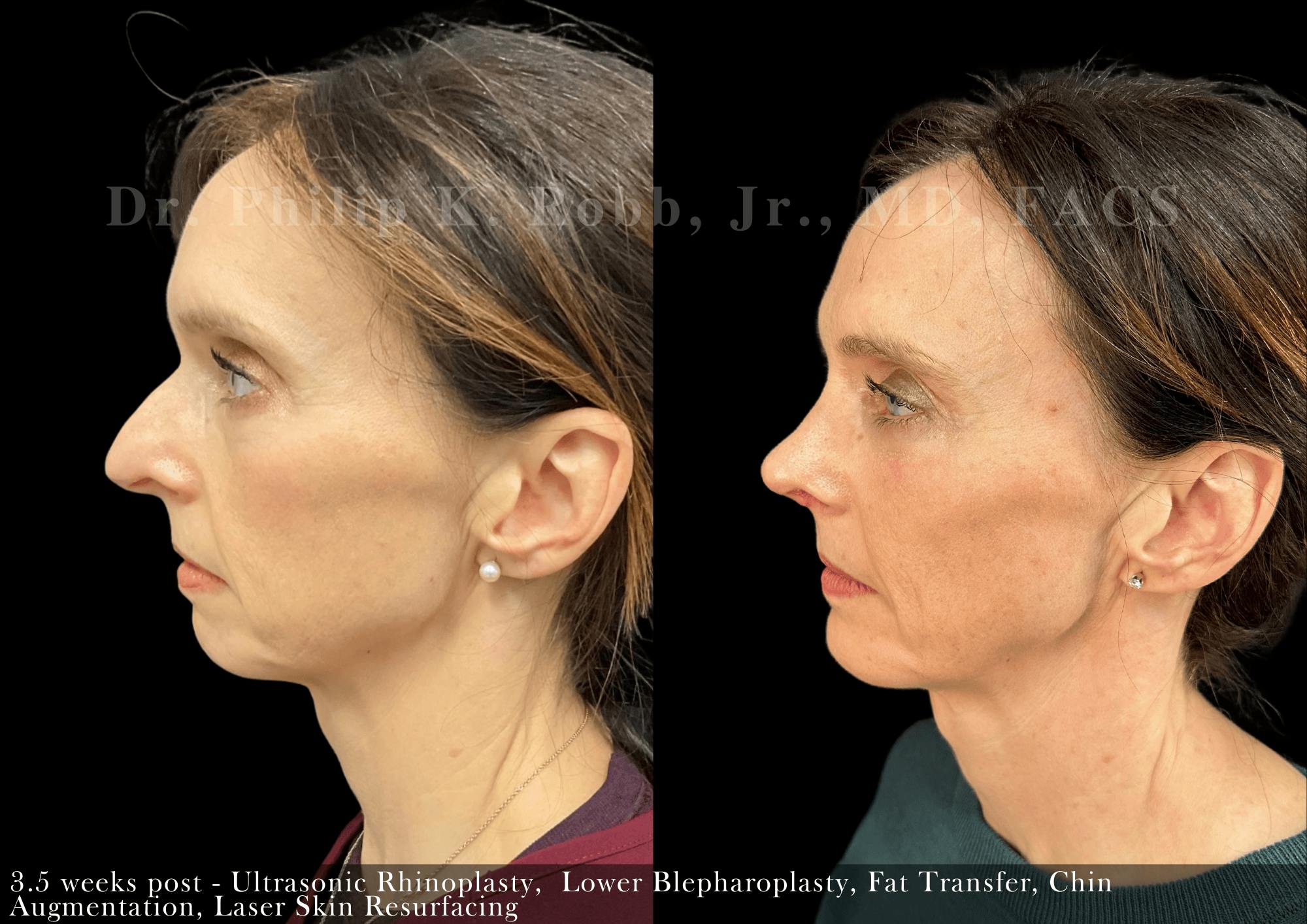 Nose Before & After Gallery - Patient 264906 - Image 5