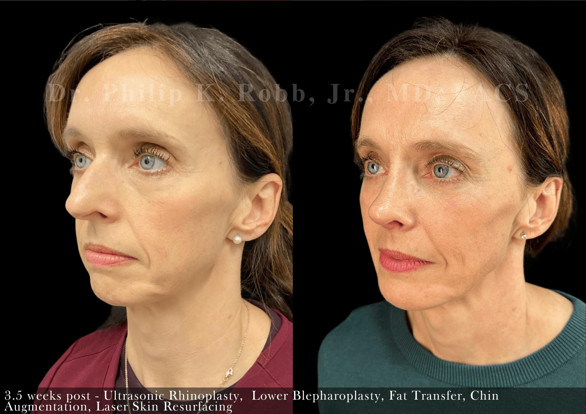 Face Before & After Gallery - Patient 242055 - Image 2
