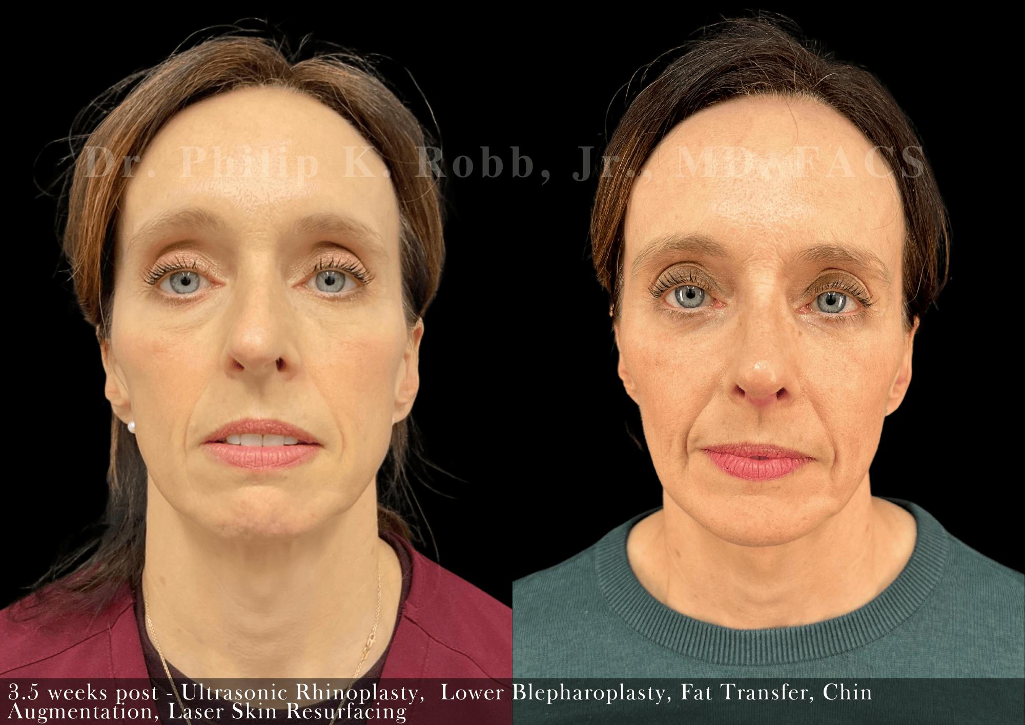 Face Before & After Gallery - Patient 242055 - Image 1