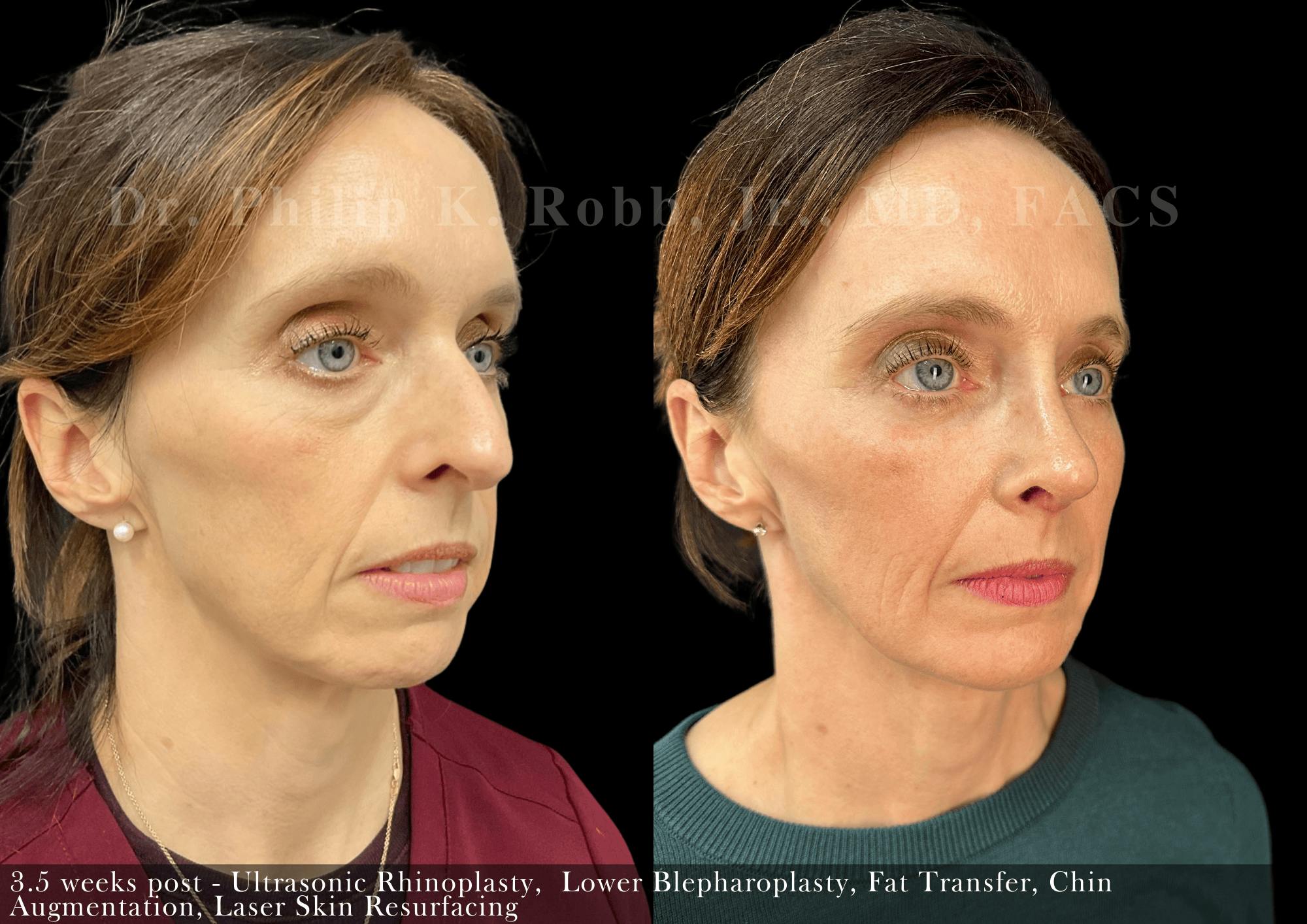 Nose Before & After Gallery - Patient 264906 - Image 2