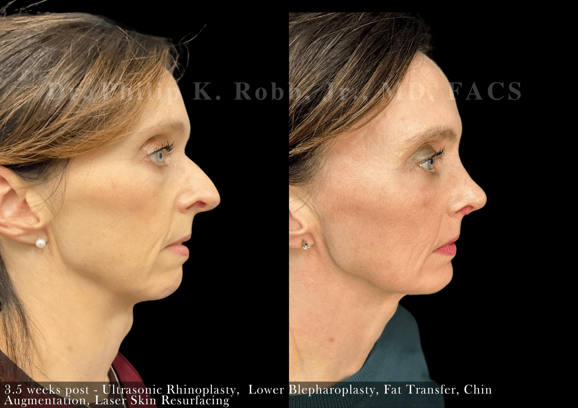 Nose Before & After Gallery - Patient 264906 - Image 1