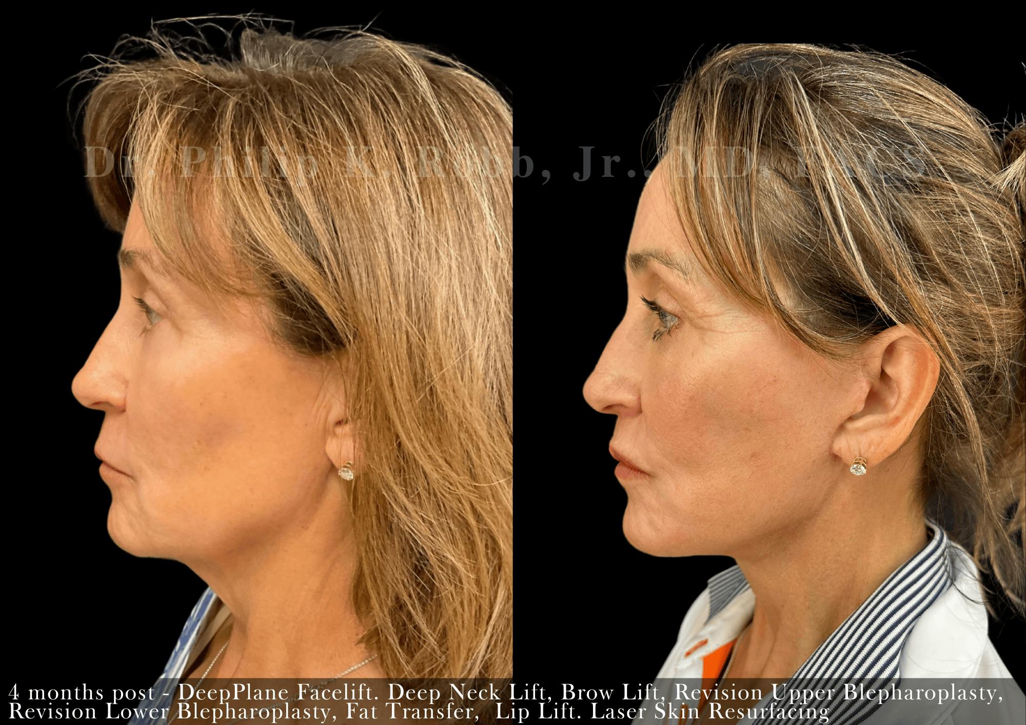Face Before & After Gallery - Patient 121303 - Image 3