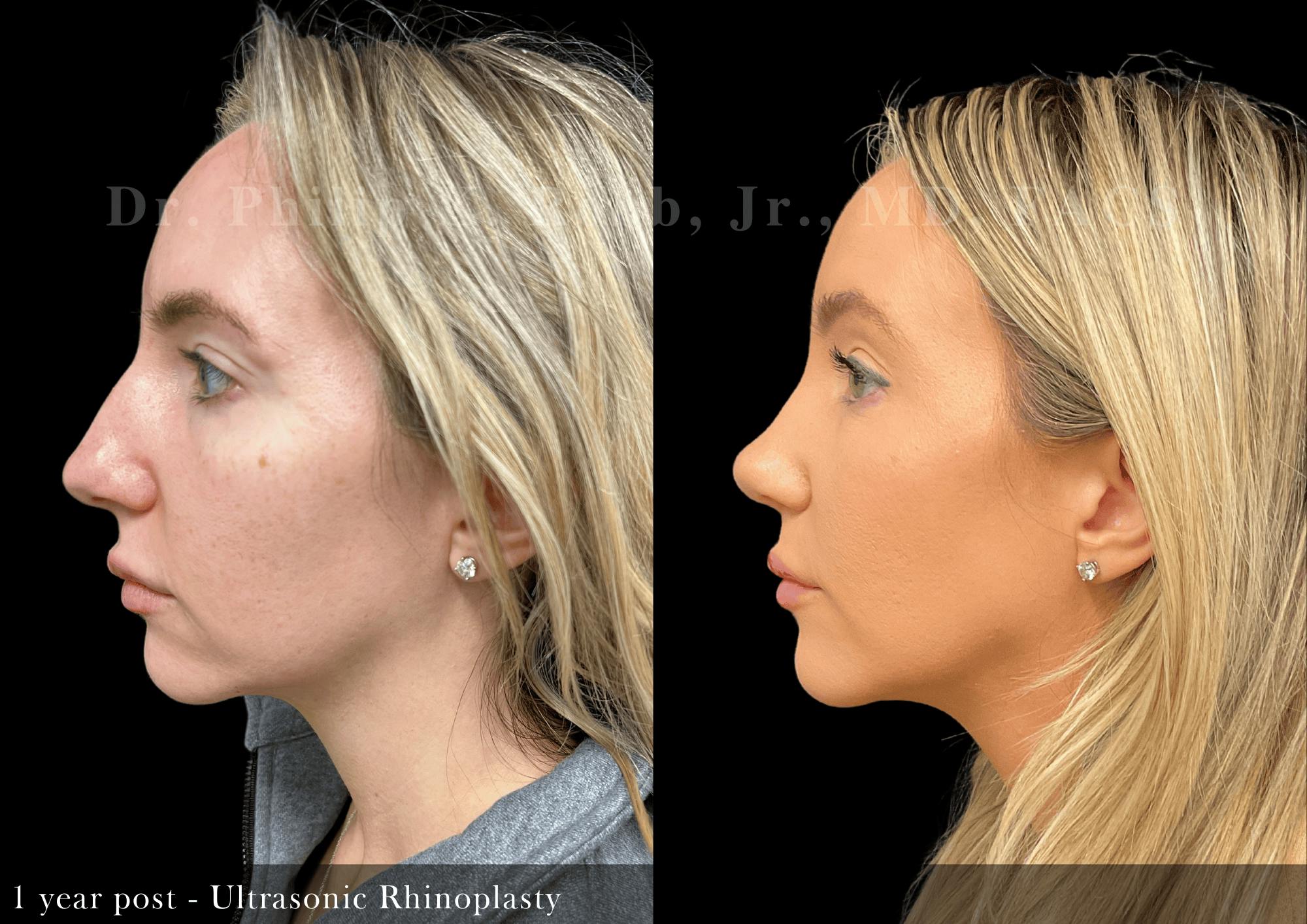 Nose Before & After Gallery - Patient 353155 - Image 5