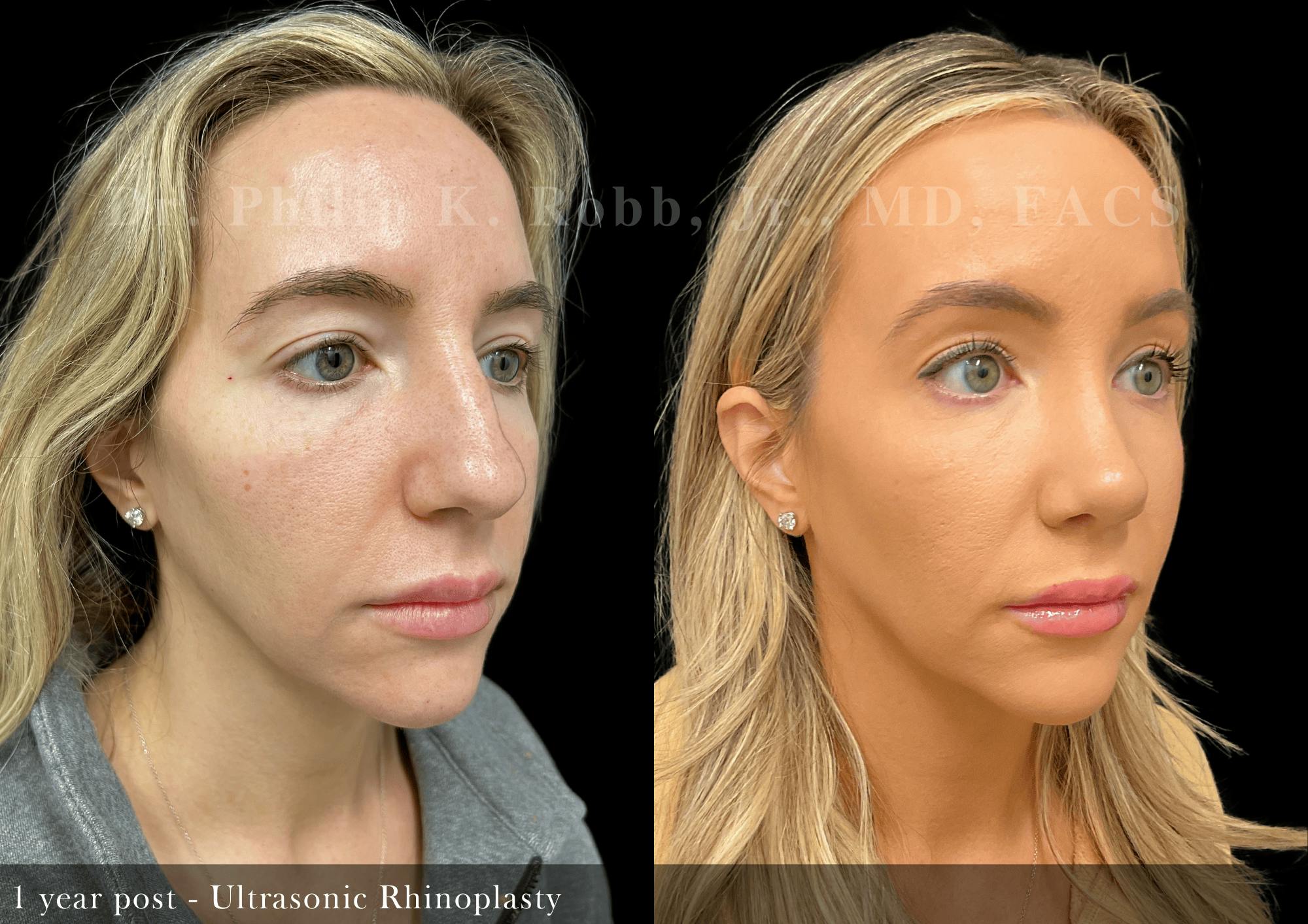Nose Before & After Gallery - Patient 353155 - Image 2