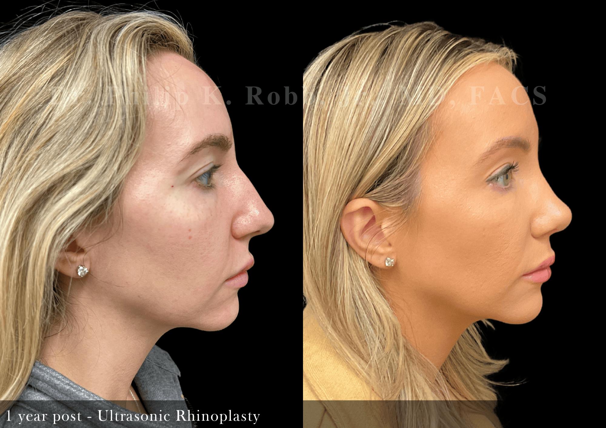 Nose Before & After Gallery - Patient 353155 - Image 1