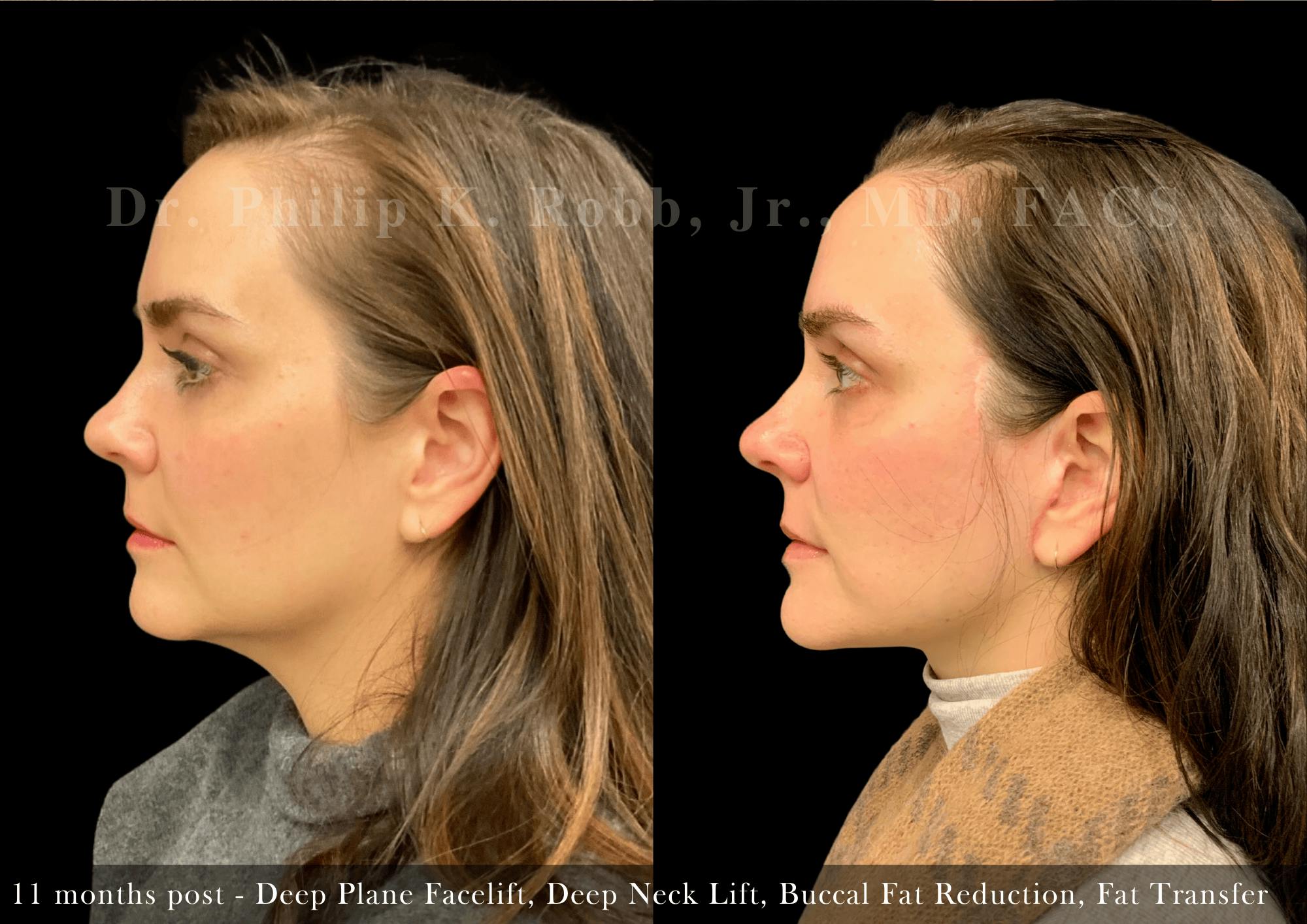 Face Before & After Gallery - Patient 383684 - Image 3