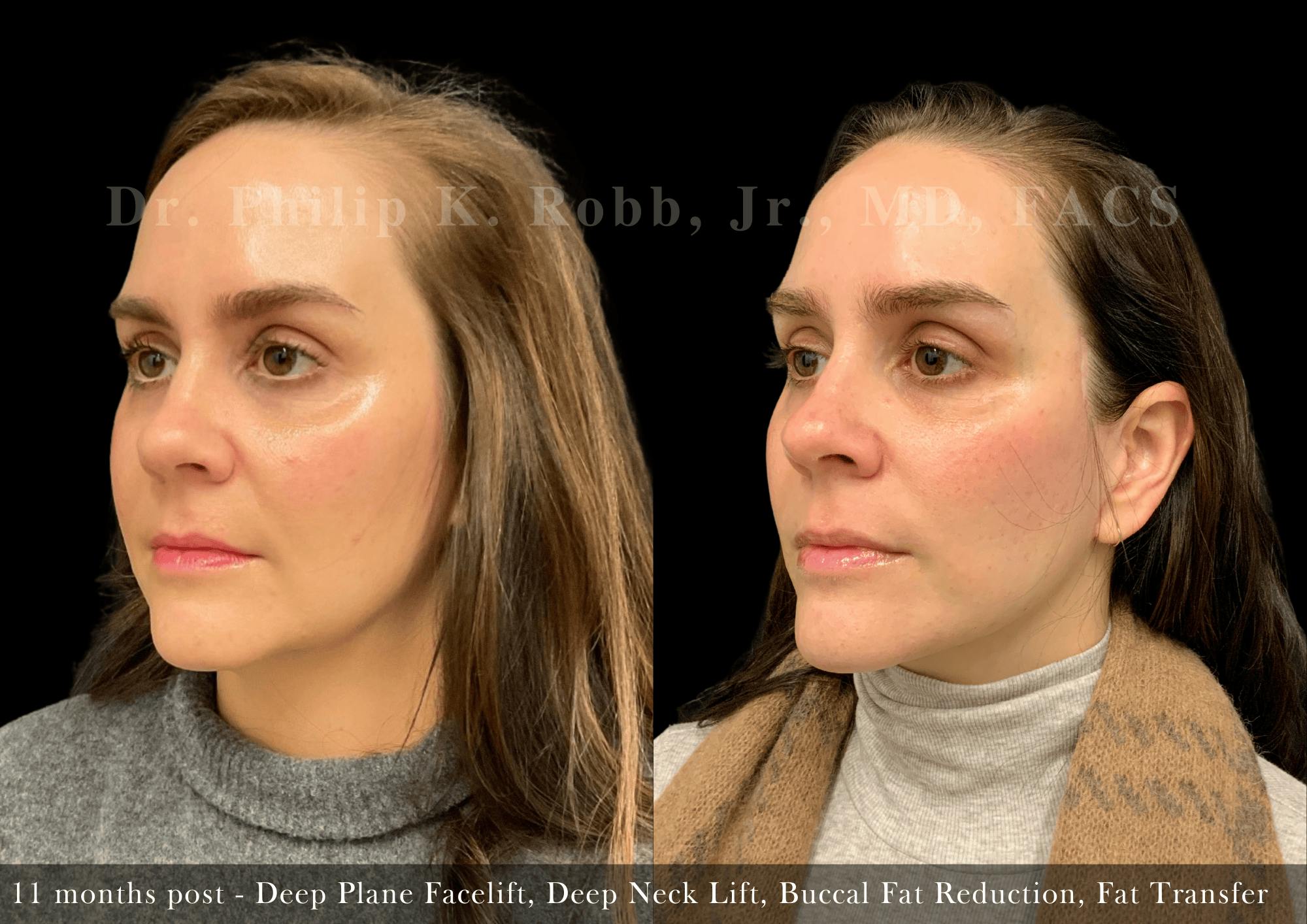 Face Before & After Gallery - Patient 383684 - Image 2