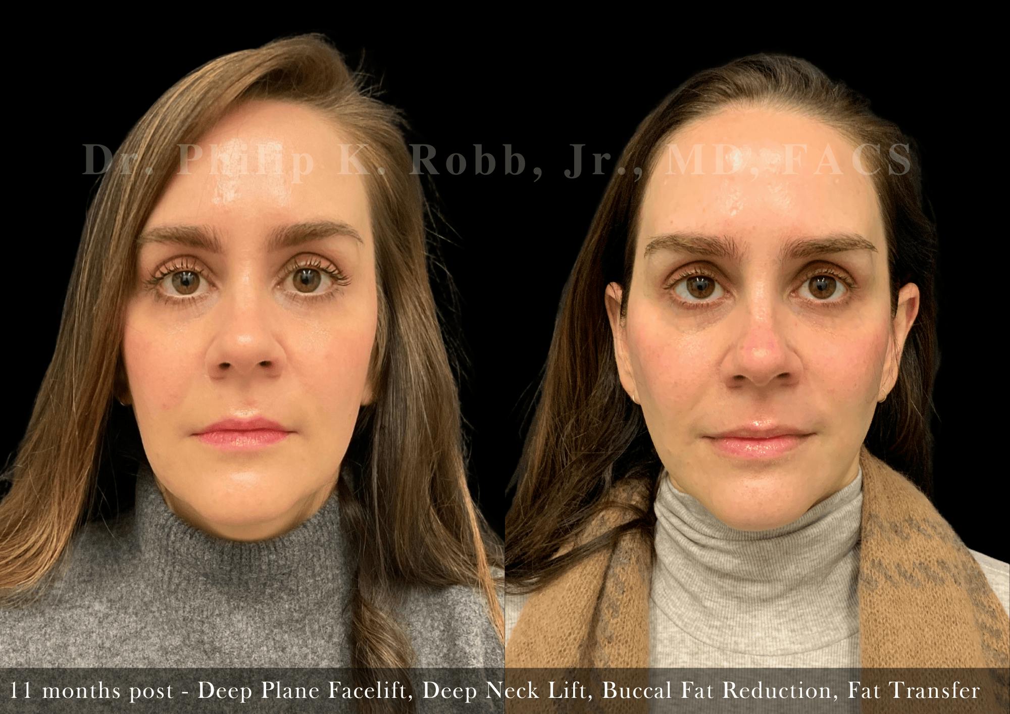 Face Before & After Gallery - Patient 383684 - Image 1