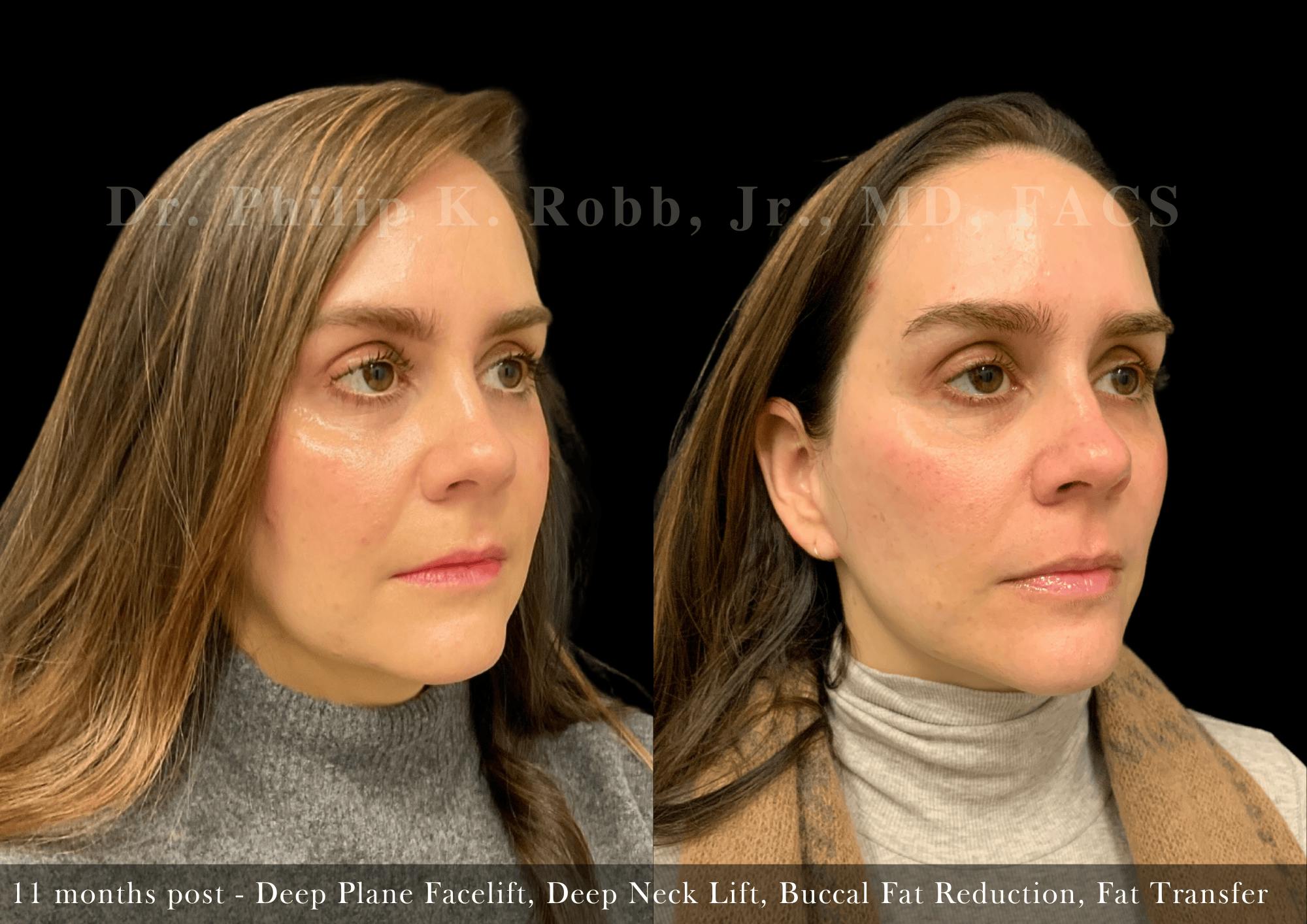 Face Before & After Gallery - Patient 383684 - Image 5