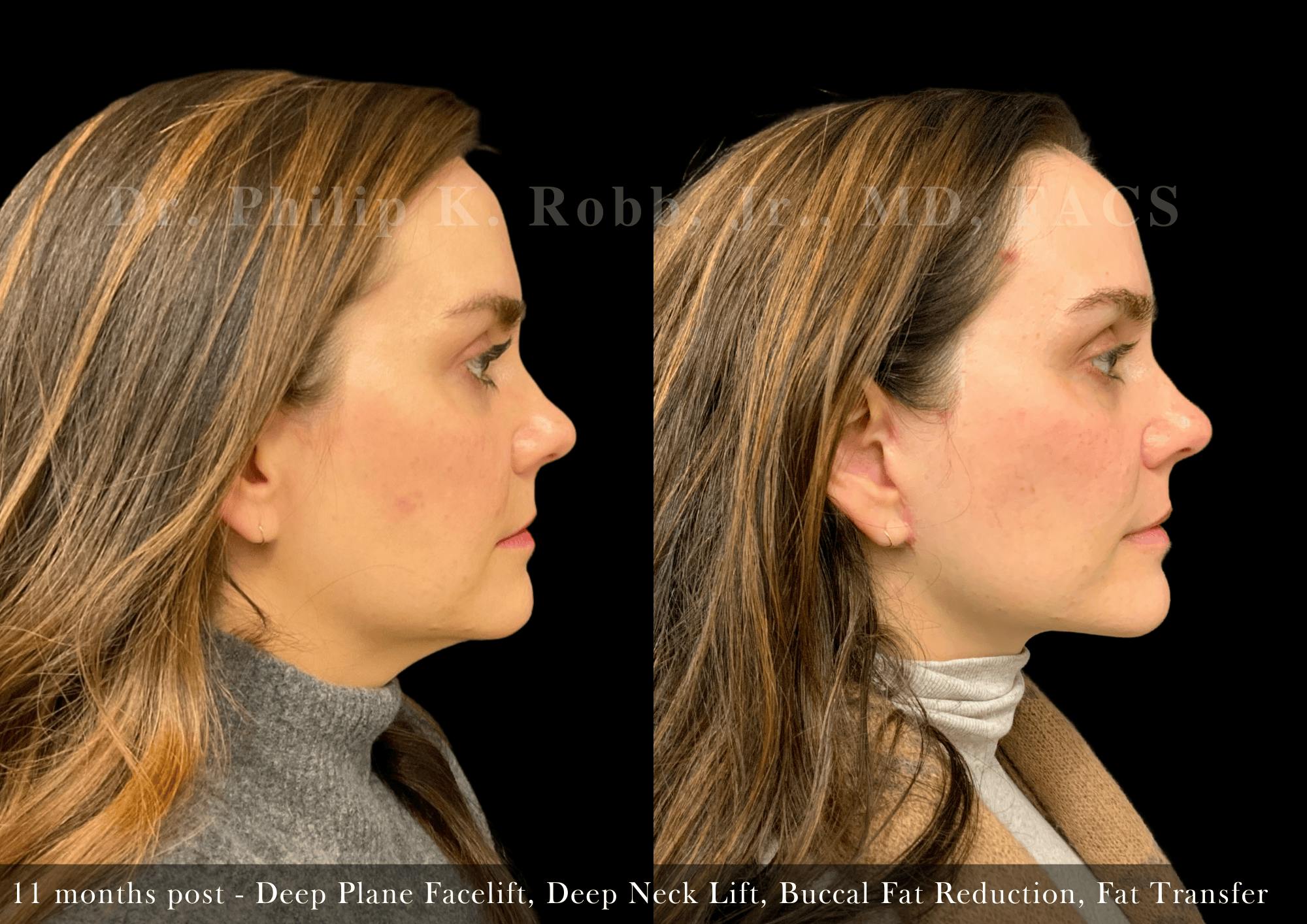 Face Before & After Gallery - Patient 383684 - Image 4
