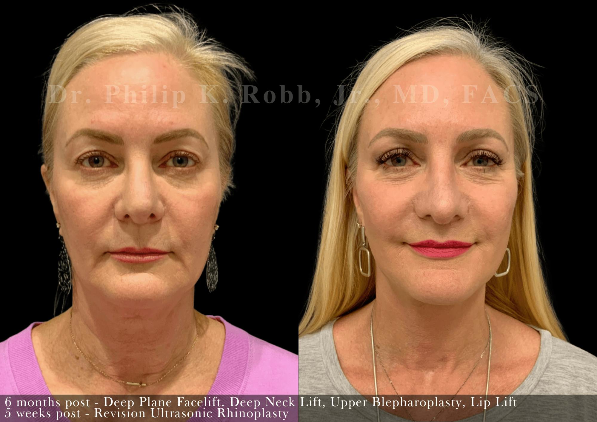 Face Before & After Gallery - Patient 310244 - Image 3