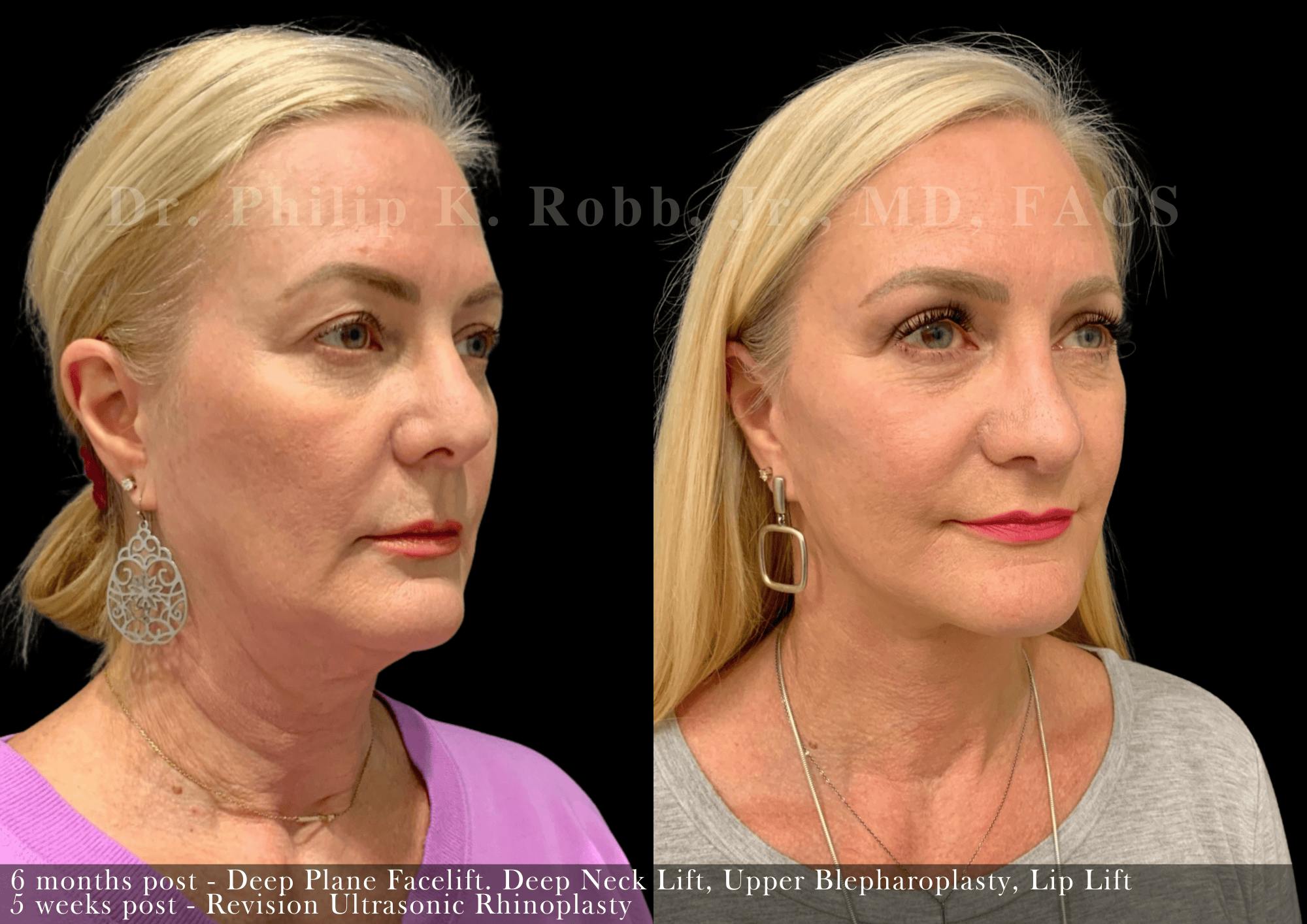 Face Before & After Gallery - Patient 310244 - Image 4