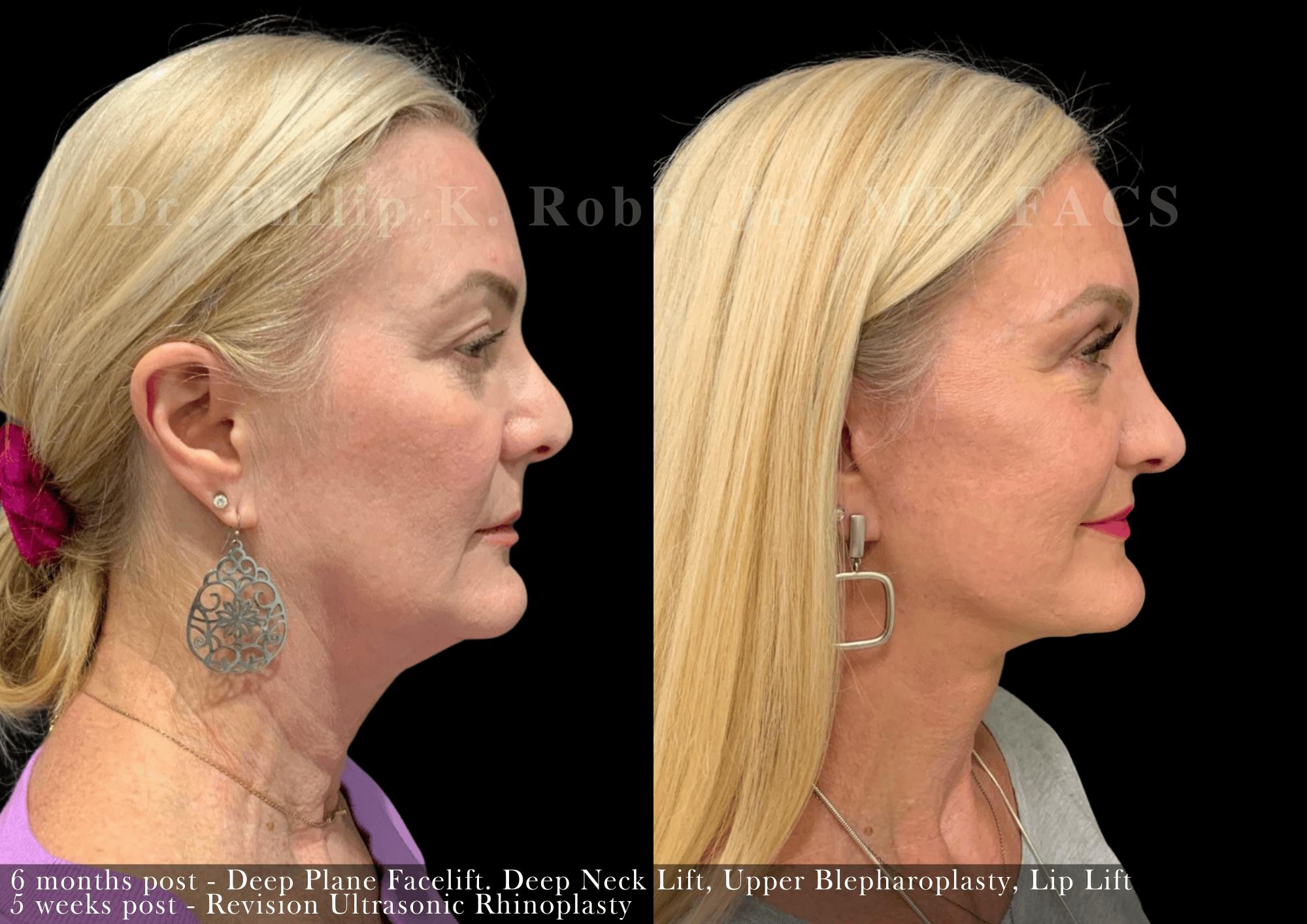 Face Before & After Gallery - Patient 310244 - Image 5